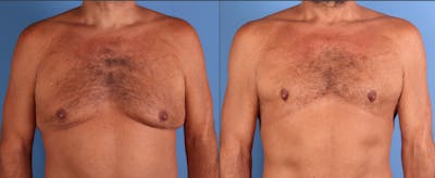 Male Breast Reduction Before & After Gallery - Patient 216233 - Image 1