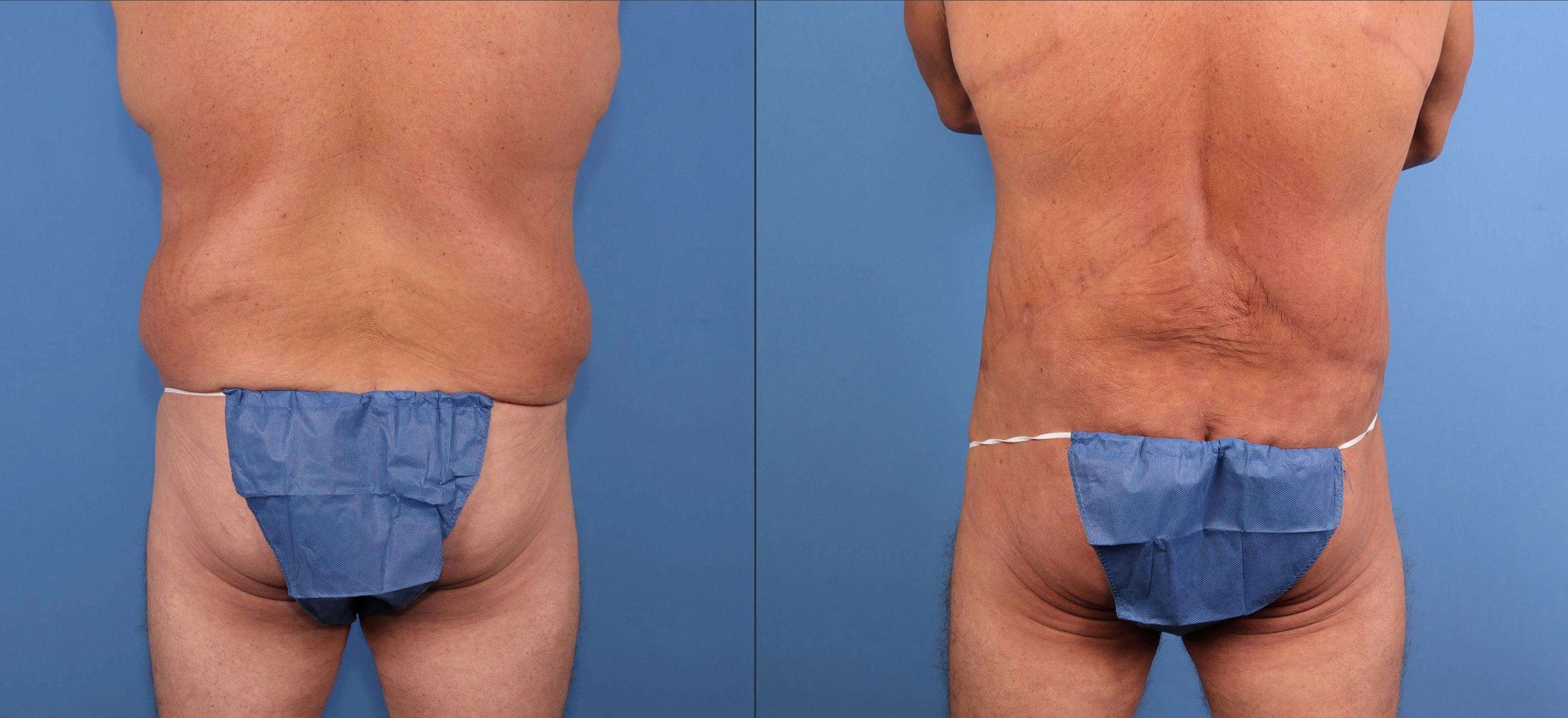 Body Lift Before & After Gallery - Patient 392776 - Image 5