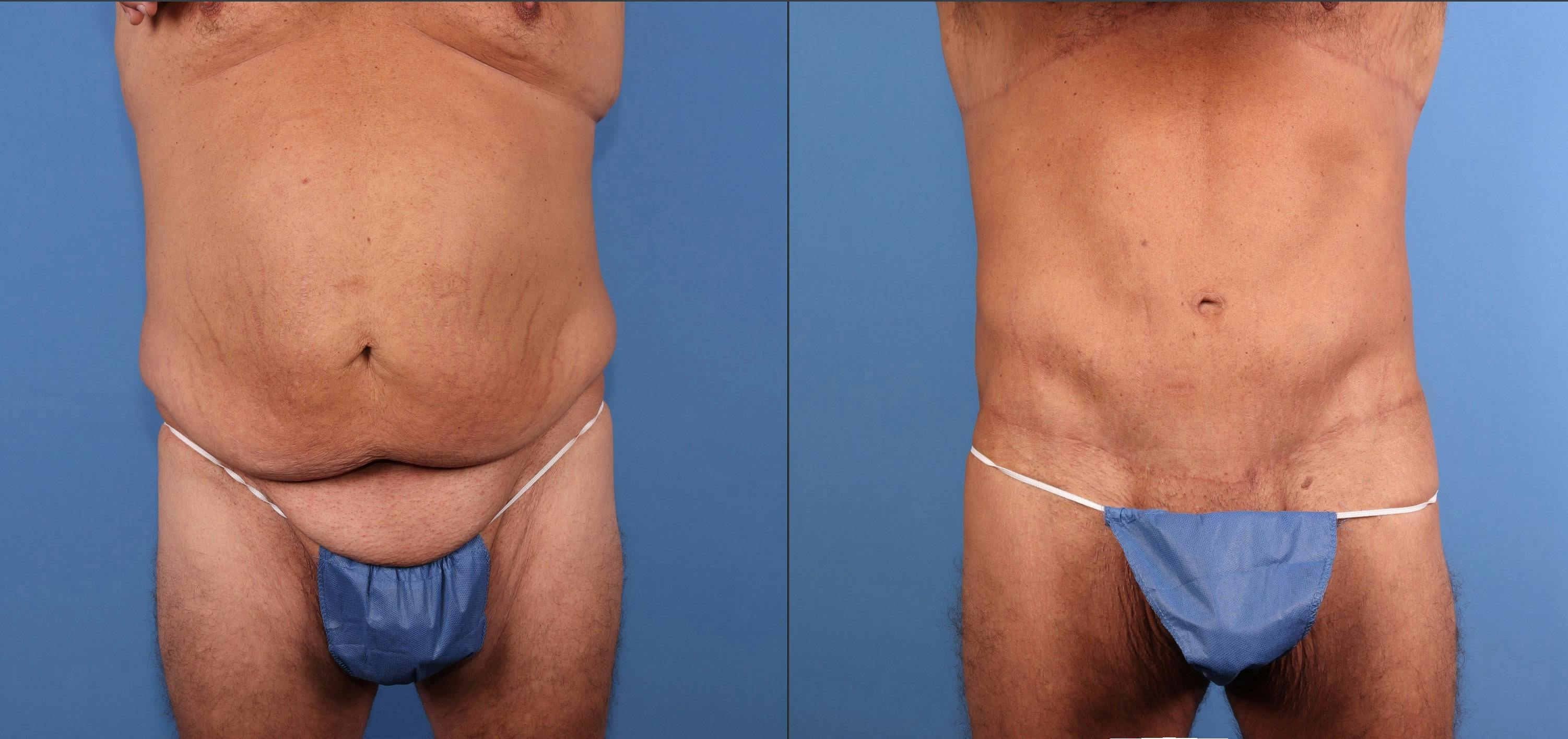 Body Lift Before & After Gallery - Patient 392776 - Image 1