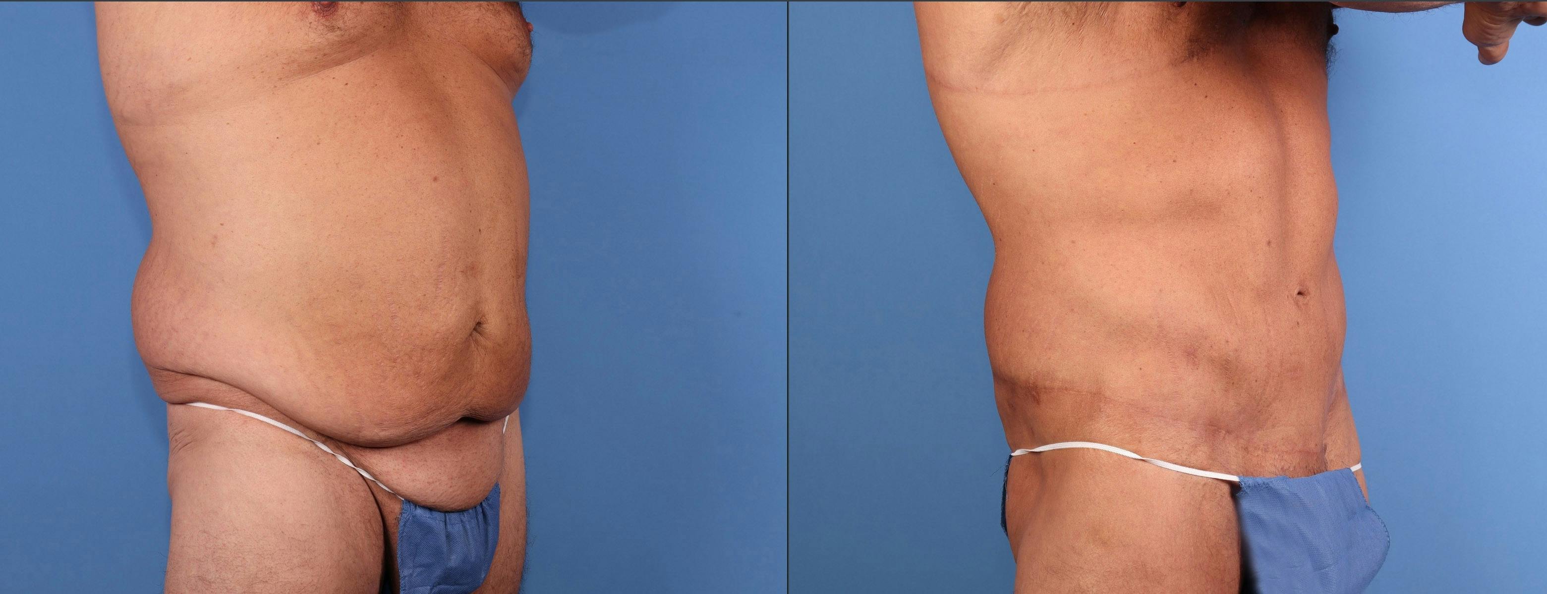 Body Lift Before & After Gallery - Patient 392776 - Image 2