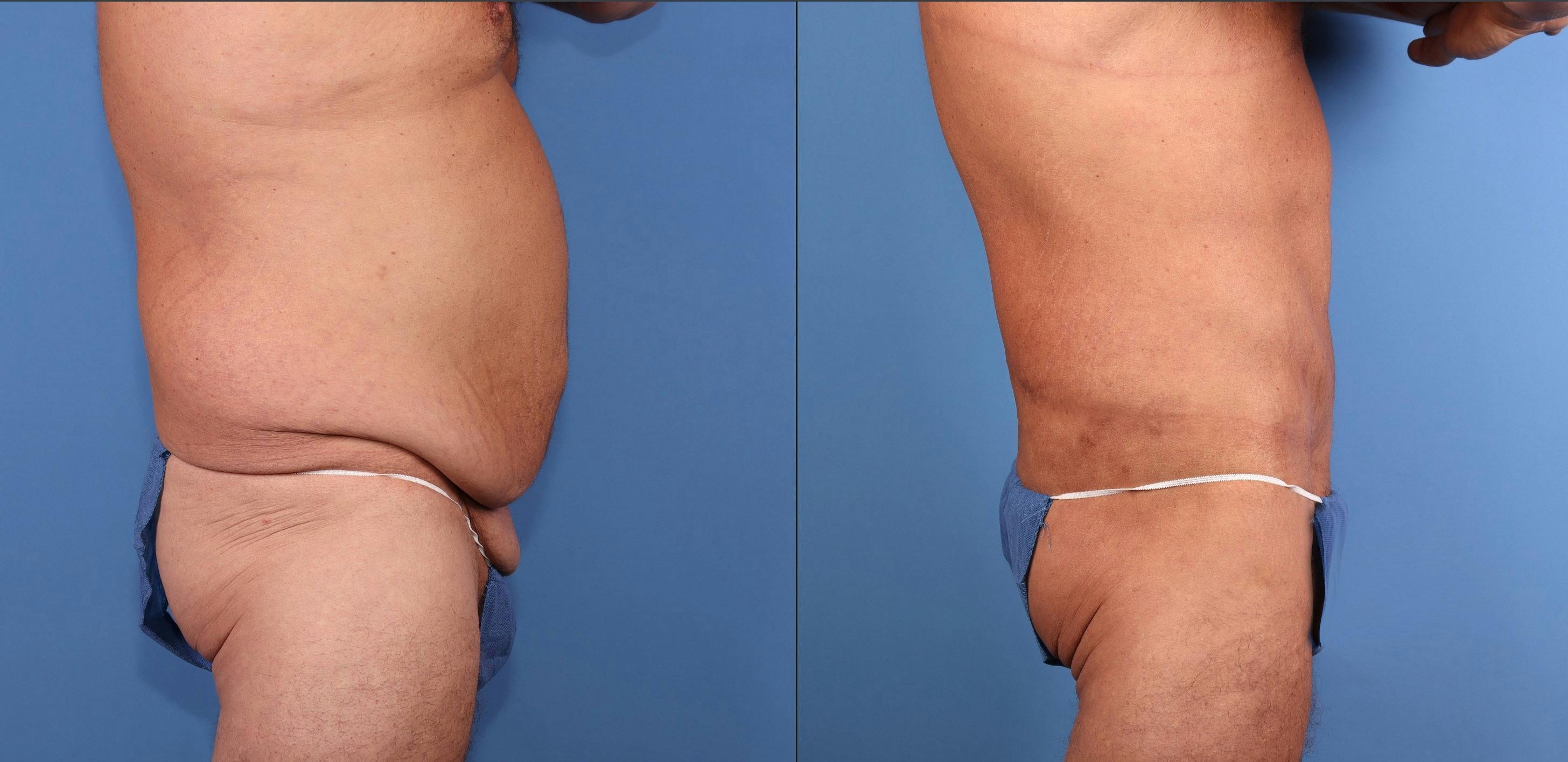 Body Lift Before & After Gallery - Patient 392776 - Image 4