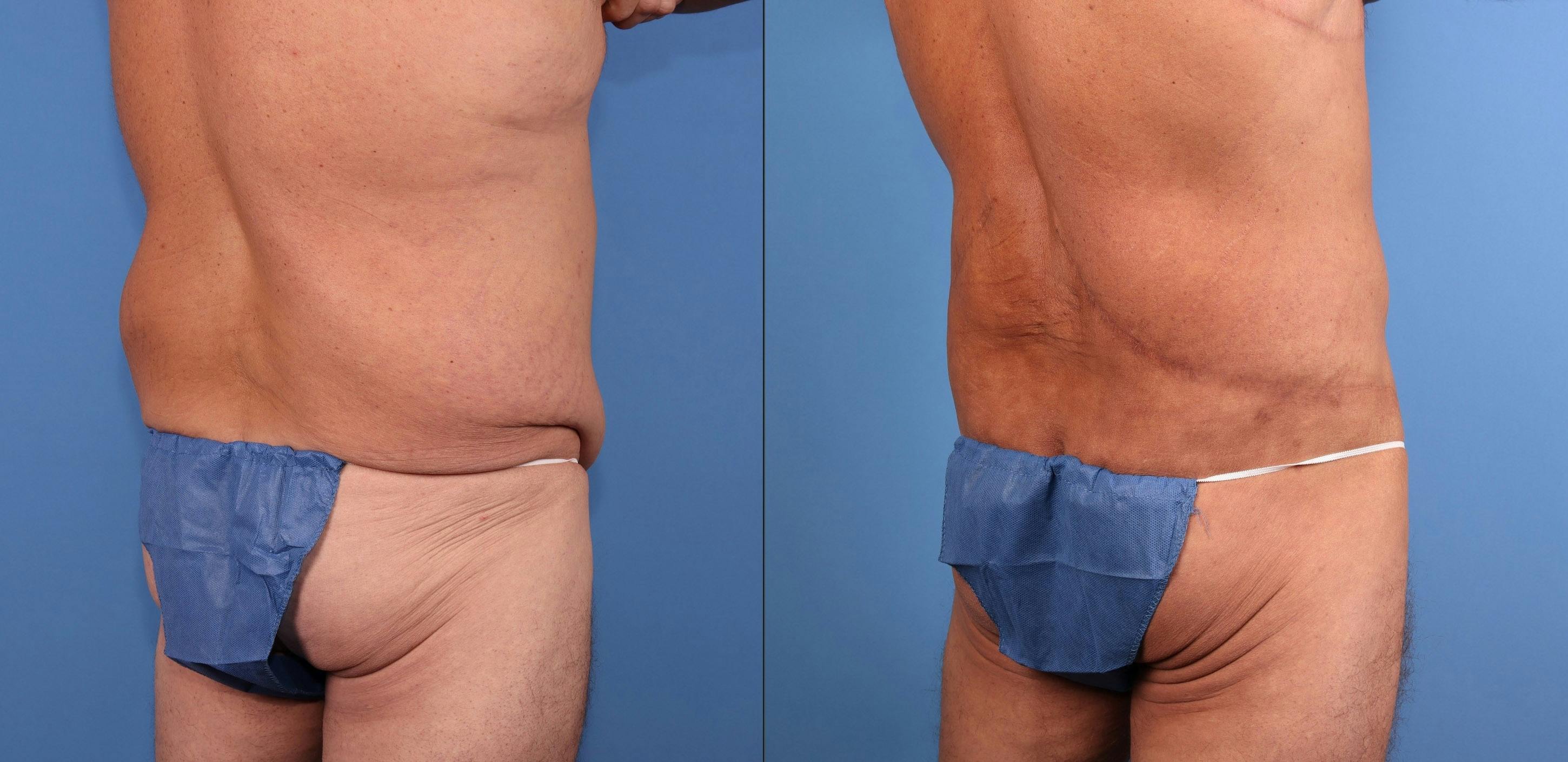 Body Lift Before & After Gallery - Patient 392776 - Image 3