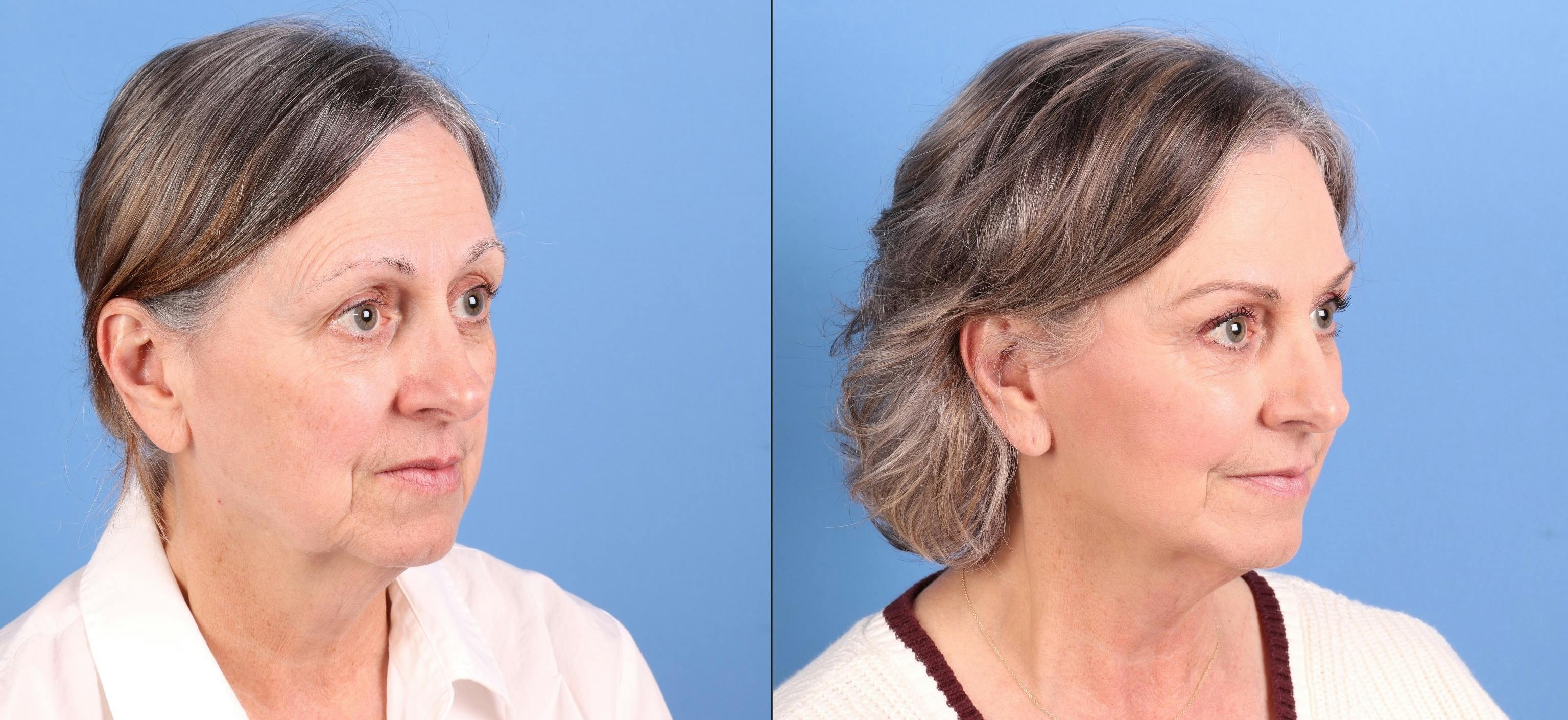 Face Lift Before & After Gallery - Patient 282664 - Image 2