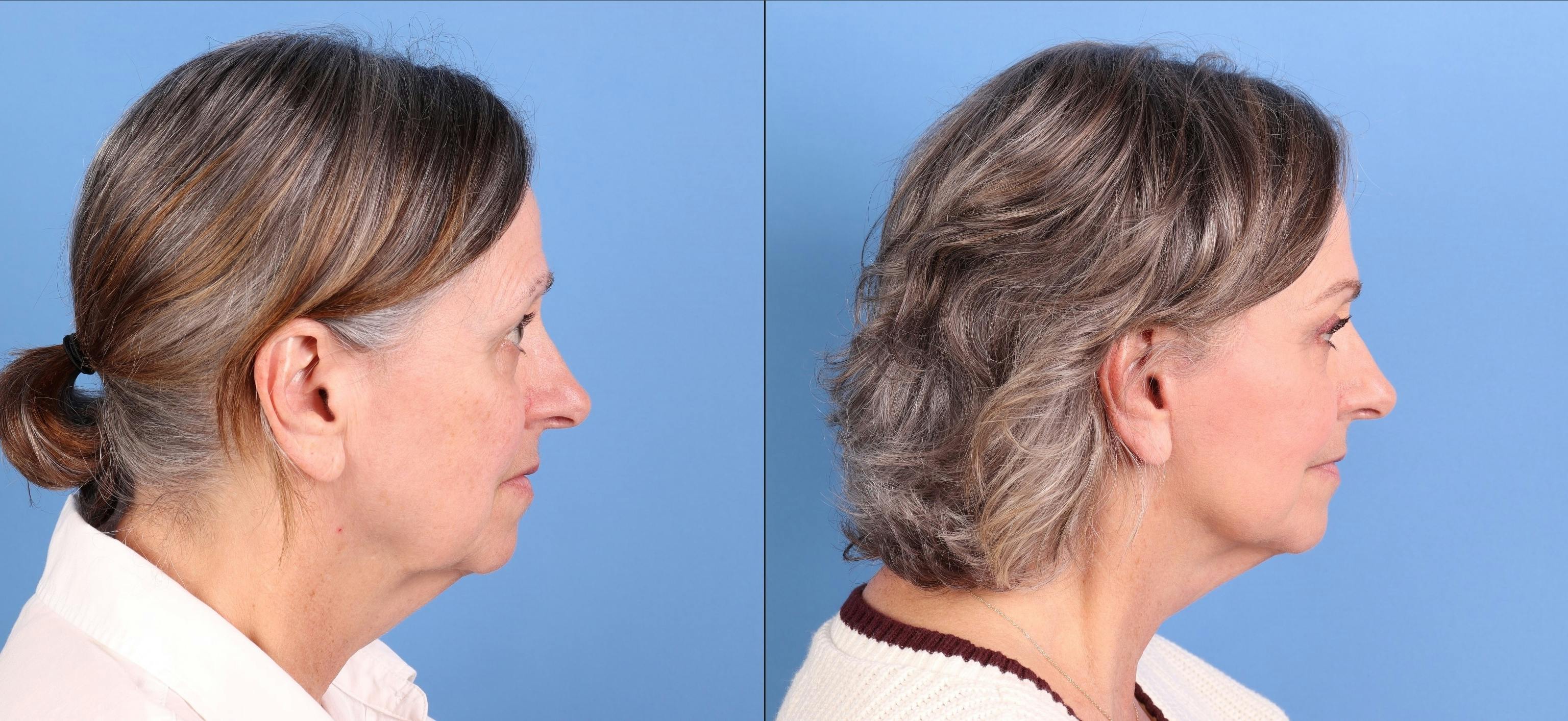 Face Lift Before & After Gallery - Patient 282664 - Image 3