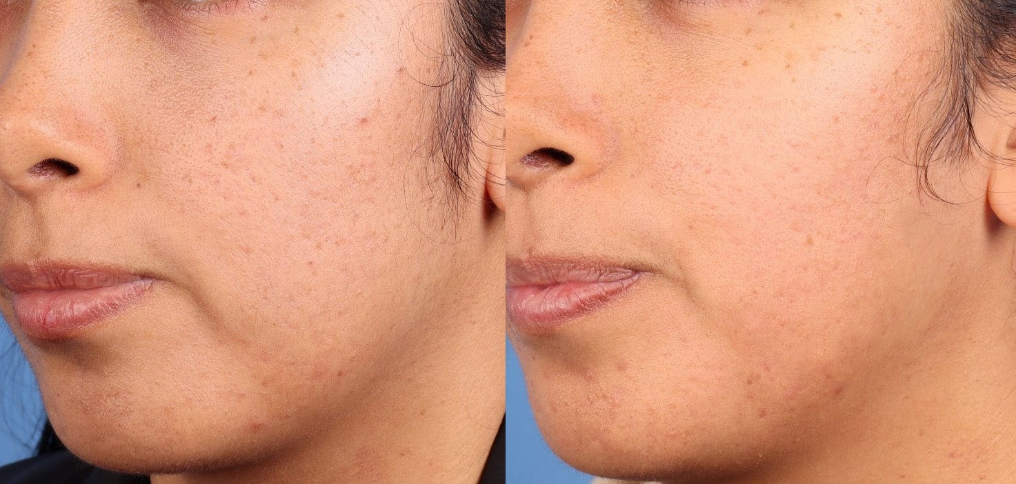 Contour TRL Laser Before & After Gallery - Patient 389706 - Image 4