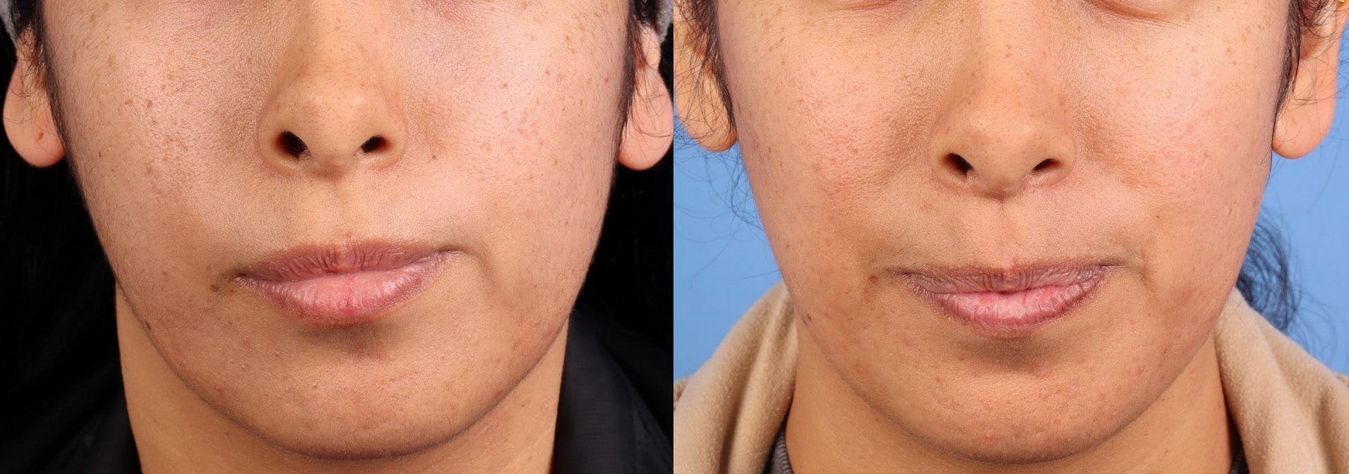Contour TRL Laser Before & After Gallery - Patient 389706 - Image 2