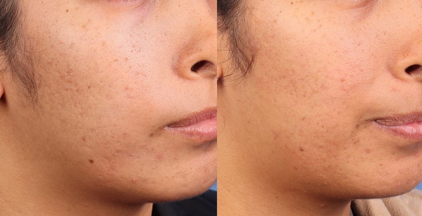 Contour TRL Laser Before & After Gallery - Patient 389706 - Image 1