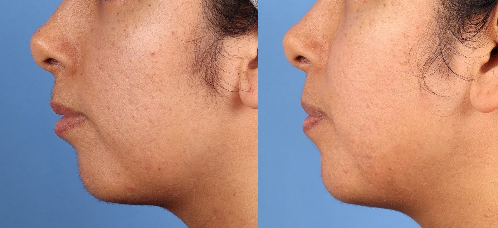 Contour TRL Laser Before & After Gallery - Patient 389706 - Image 5