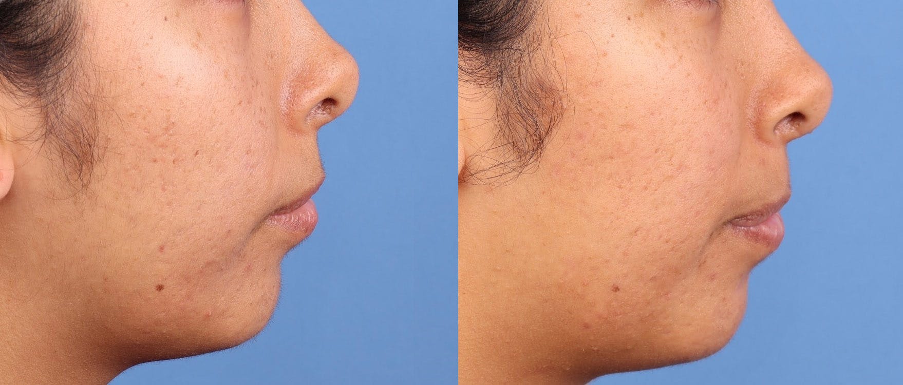 Contour TRL Laser Before & After Gallery - Patient 389706 - Image 3