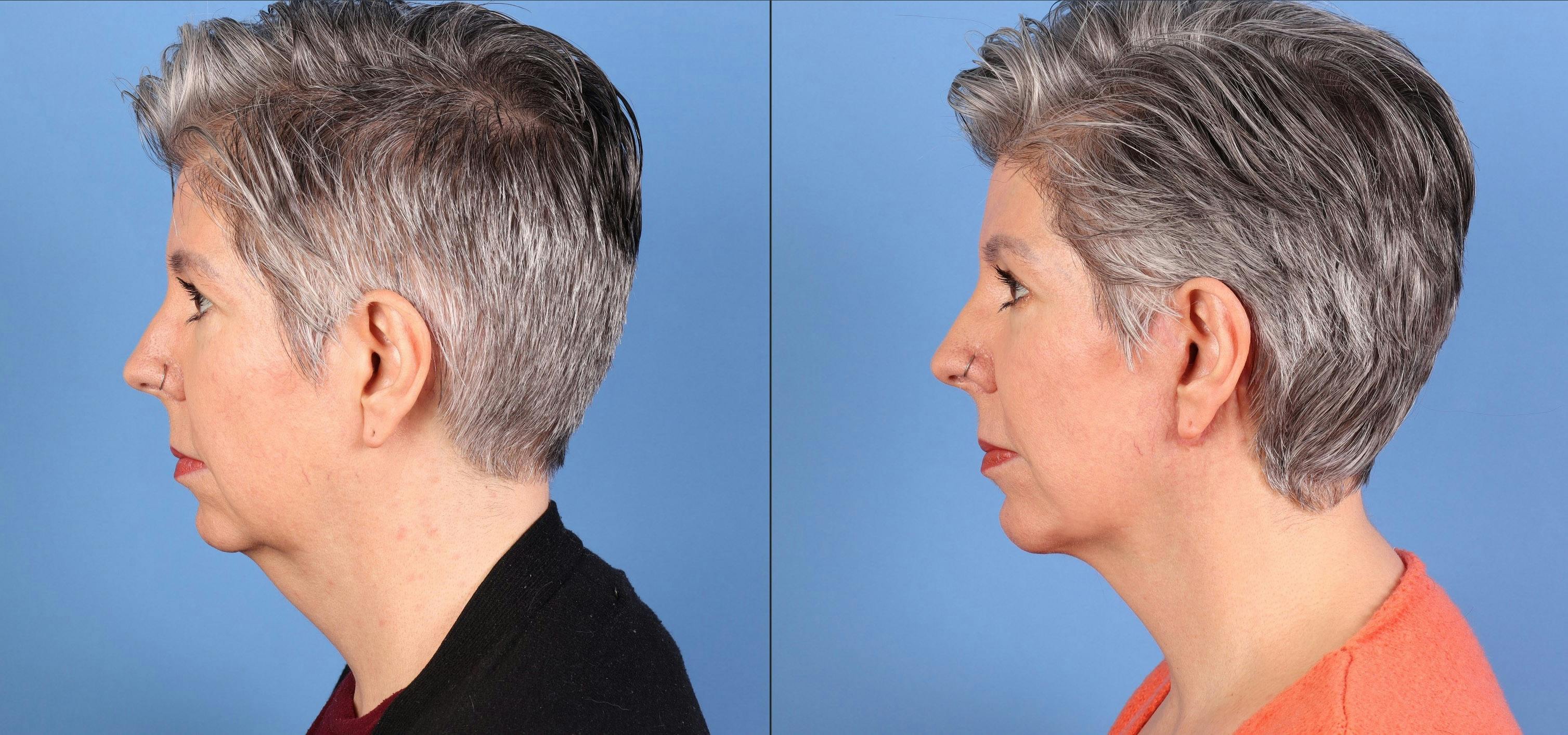 Face Lift Before & After Gallery - Patient 264665 - Image 5