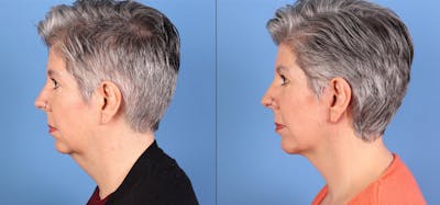 Neck Lift Before & After Gallery - Patient 328314 - Image 1
