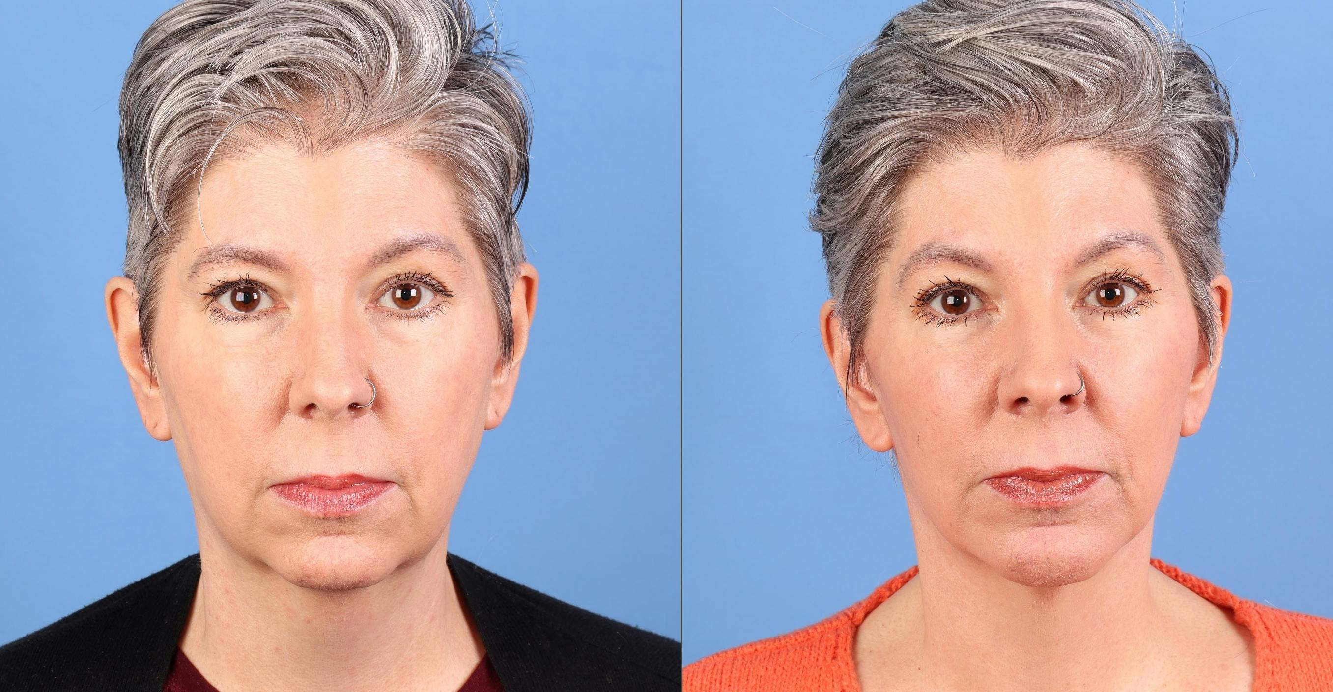 Face Lift Before & After Gallery - Patient 264665 - Image 1