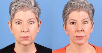 Face Lift Before & After Gallery - Patient 264665 - Image 1