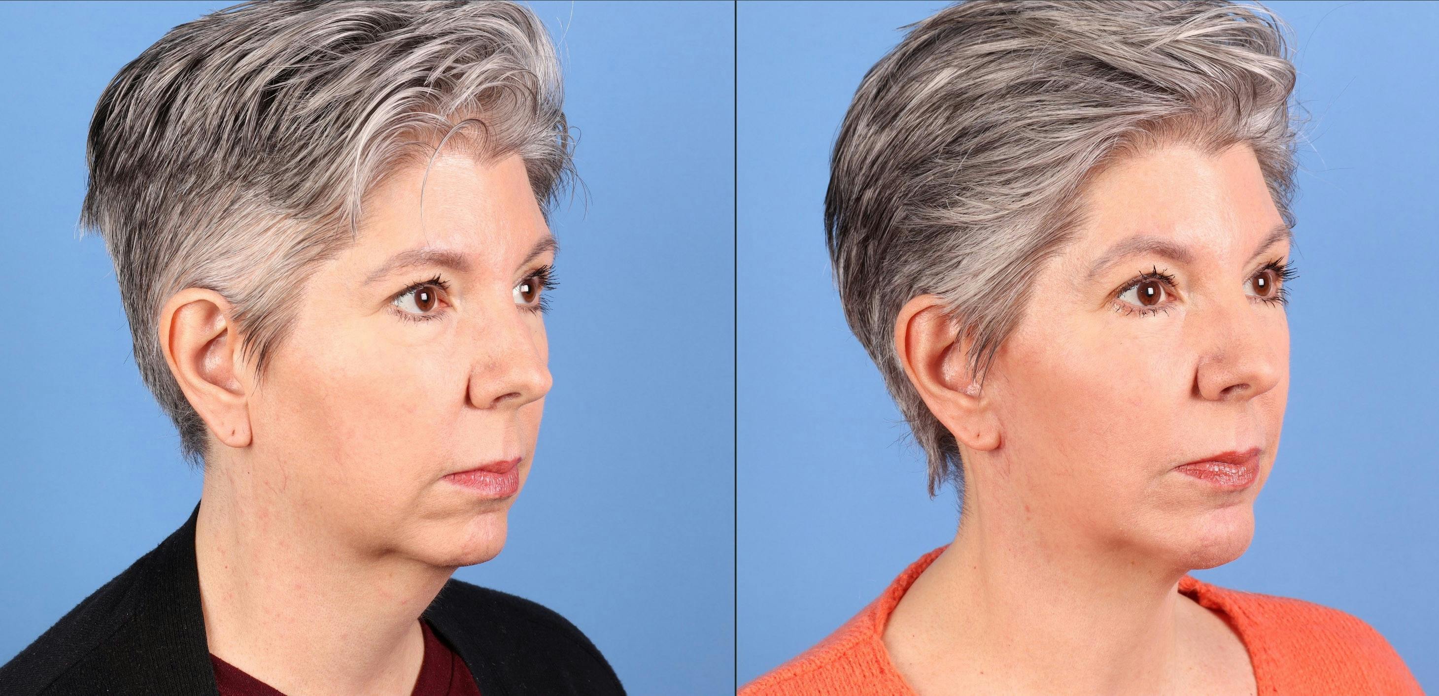 Face Lift Before & After Gallery - Patient 264665 - Image 2