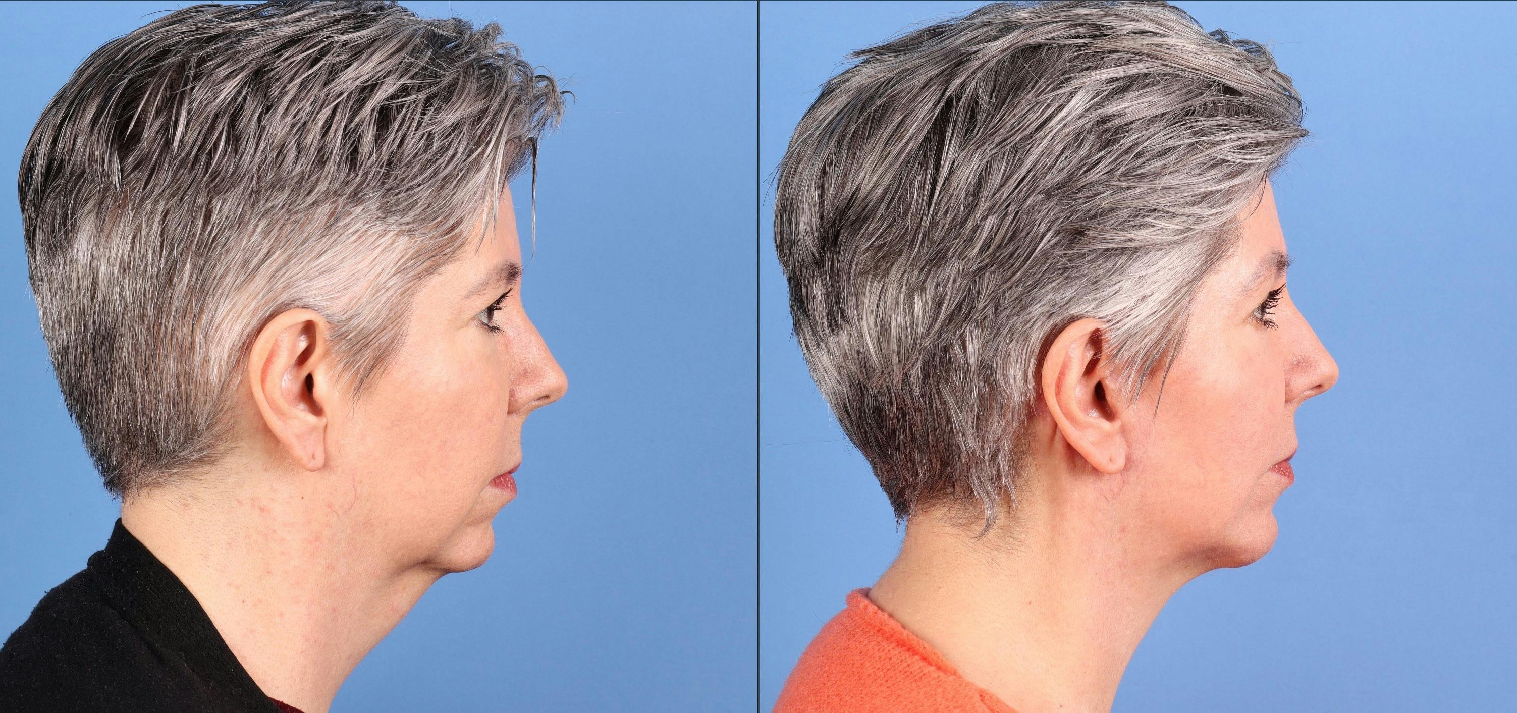 Chin Implant Before & After Gallery - Patient 256262 - Image 1