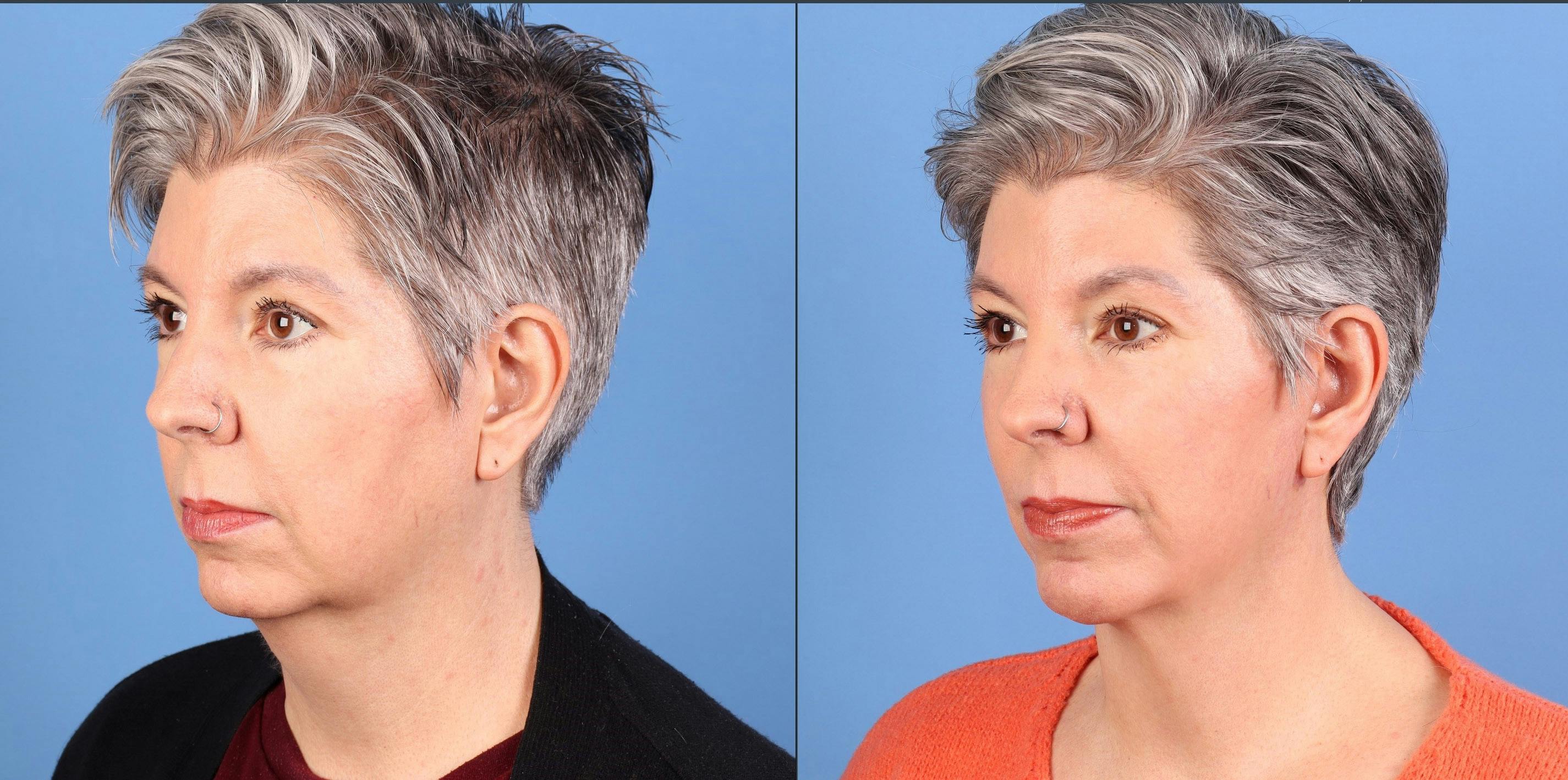 Face Lift Before & After Gallery - Patient 264665 - Image 4