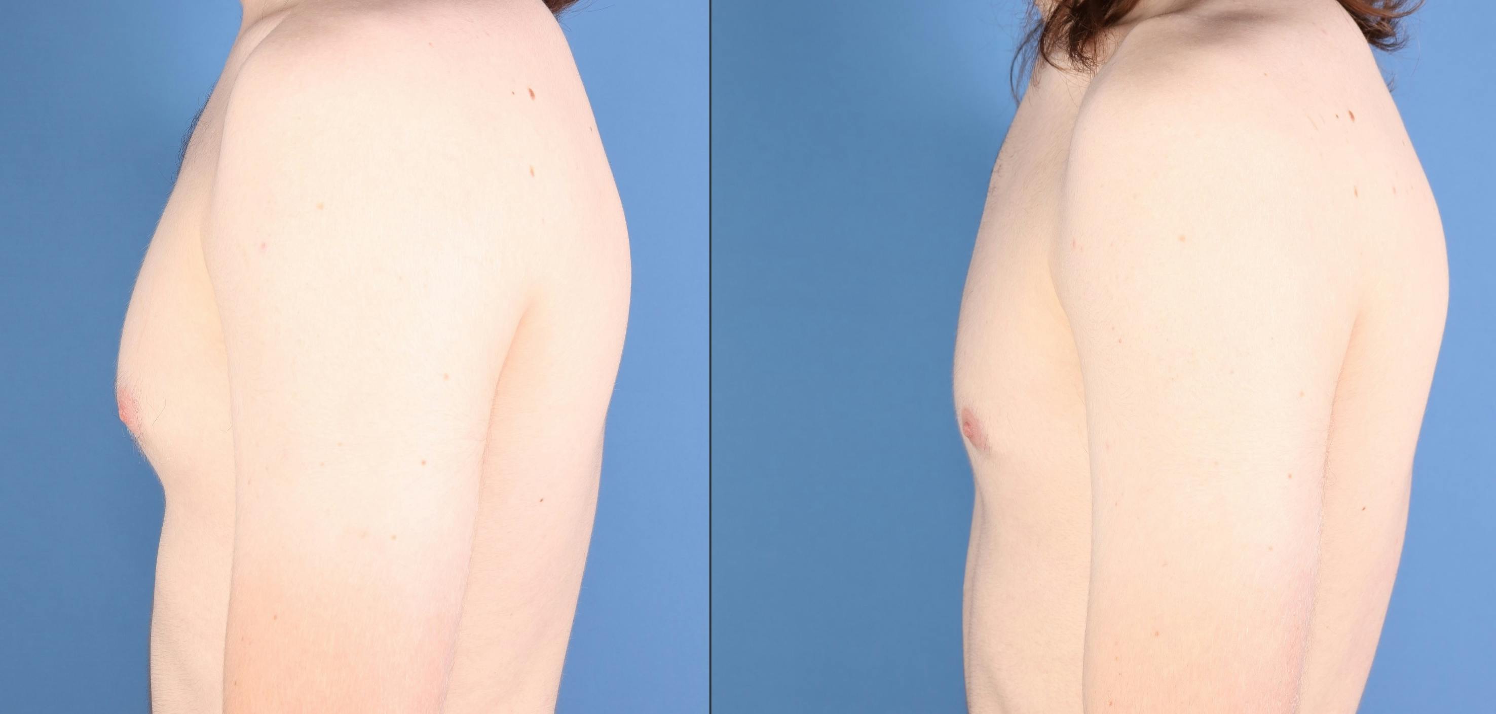 Male Breast Reduction Before & After Gallery - Patient 258036 - Image 5