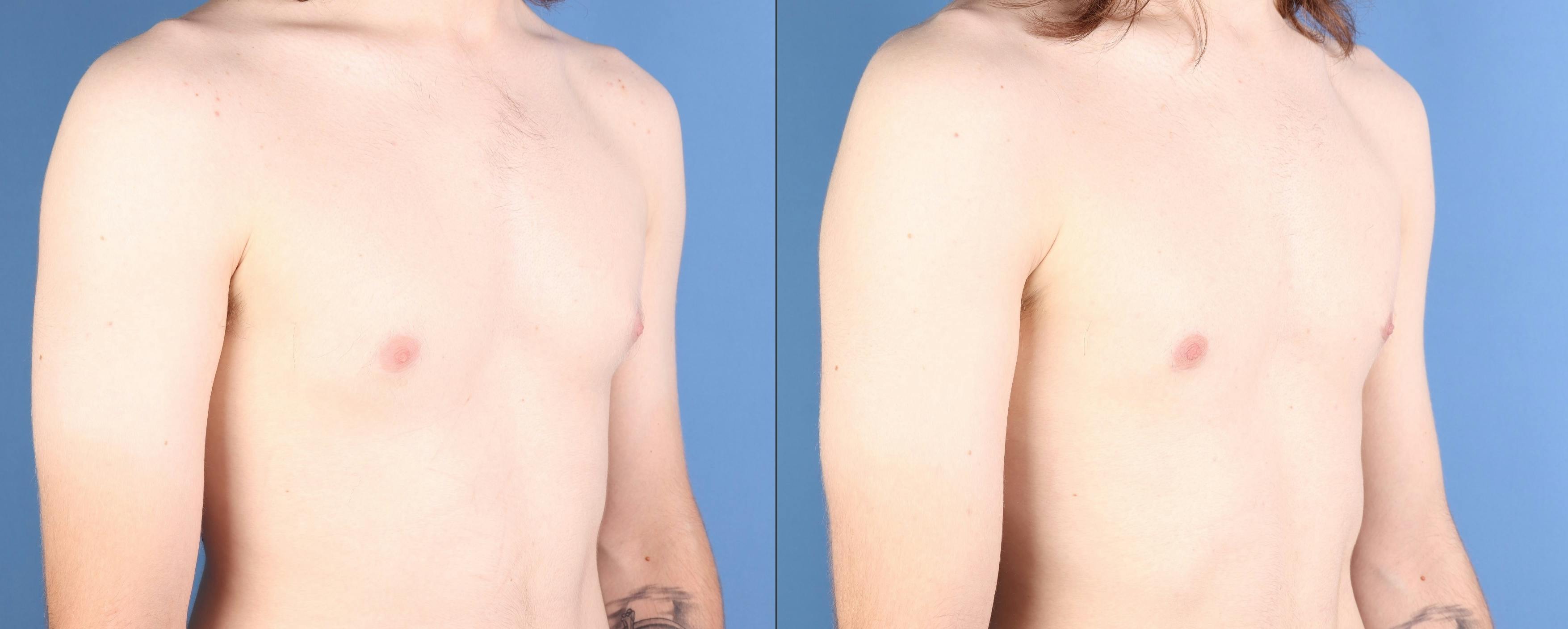 Male Breast Reduction Before & After Gallery - Patient 258036 - Image 2