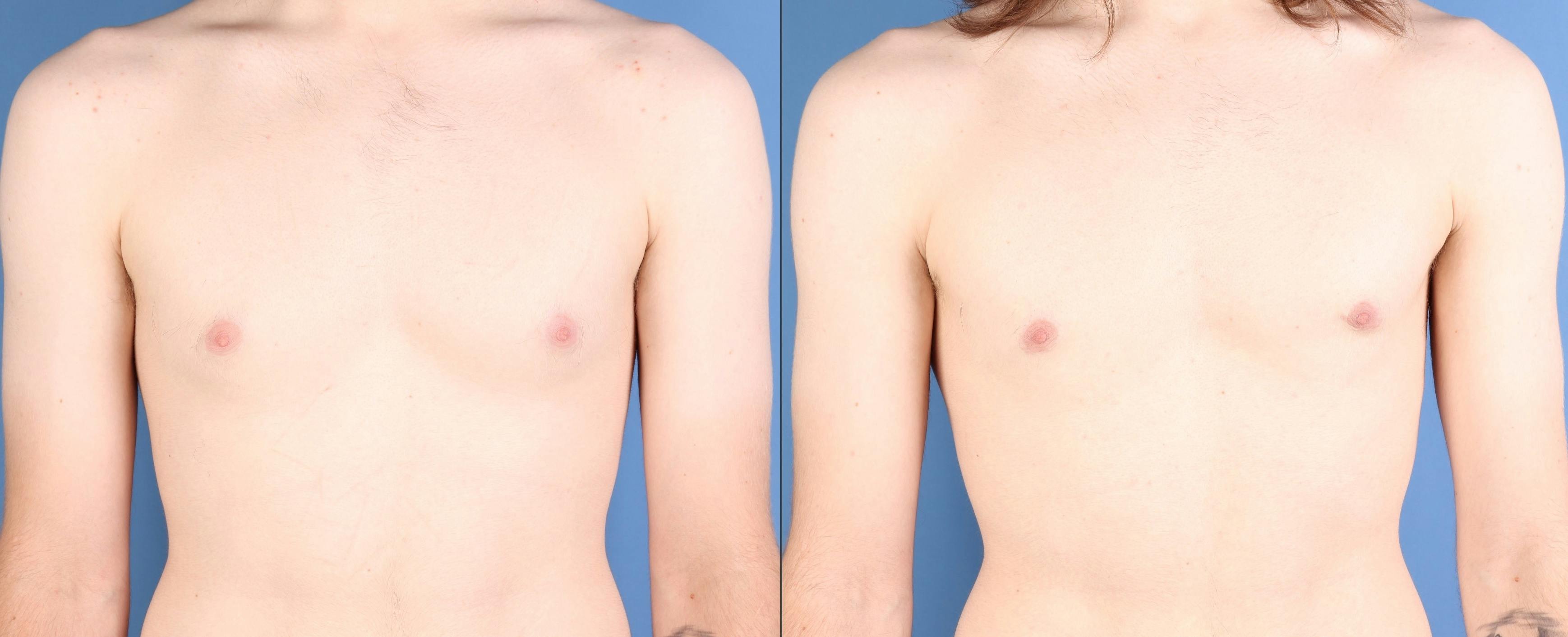 Male Breast Reduction Before & After Gallery - Patient 258036 - Image 1