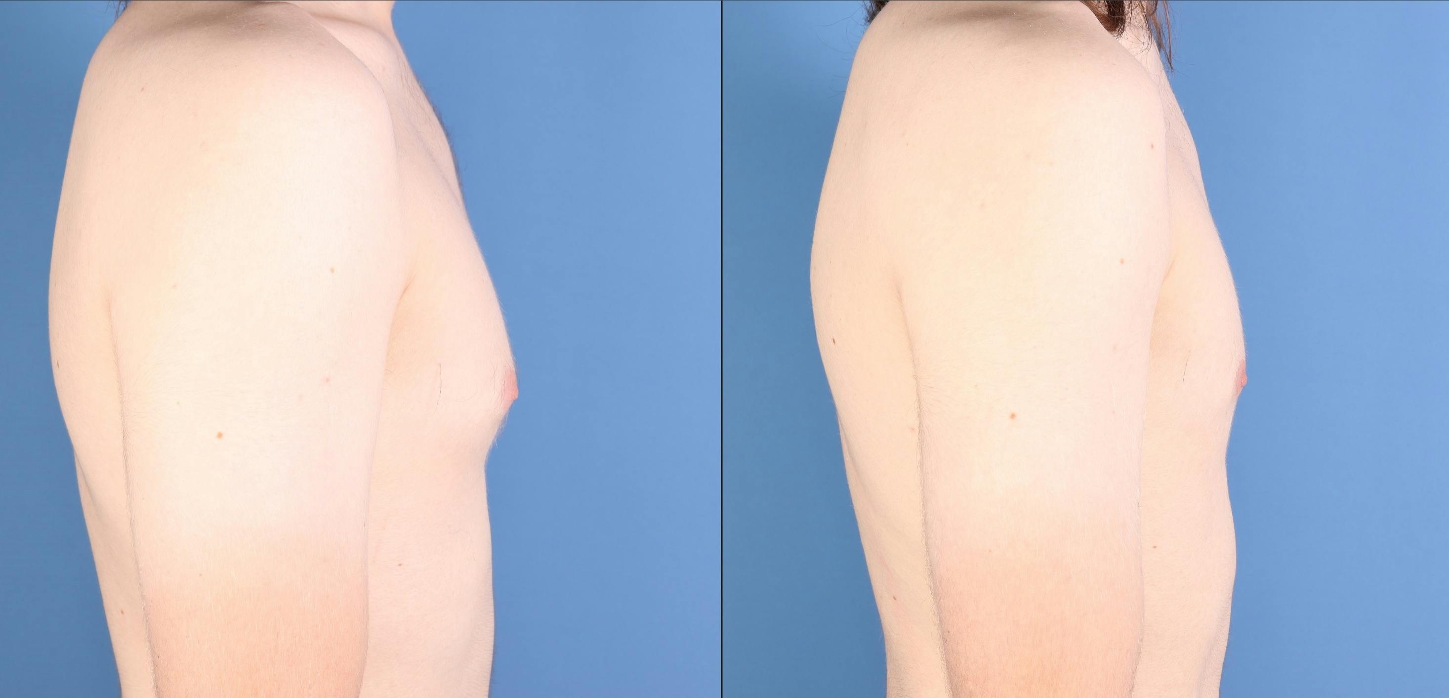 Male Breast Reduction Before & After Gallery - Patient 258036 - Image 3