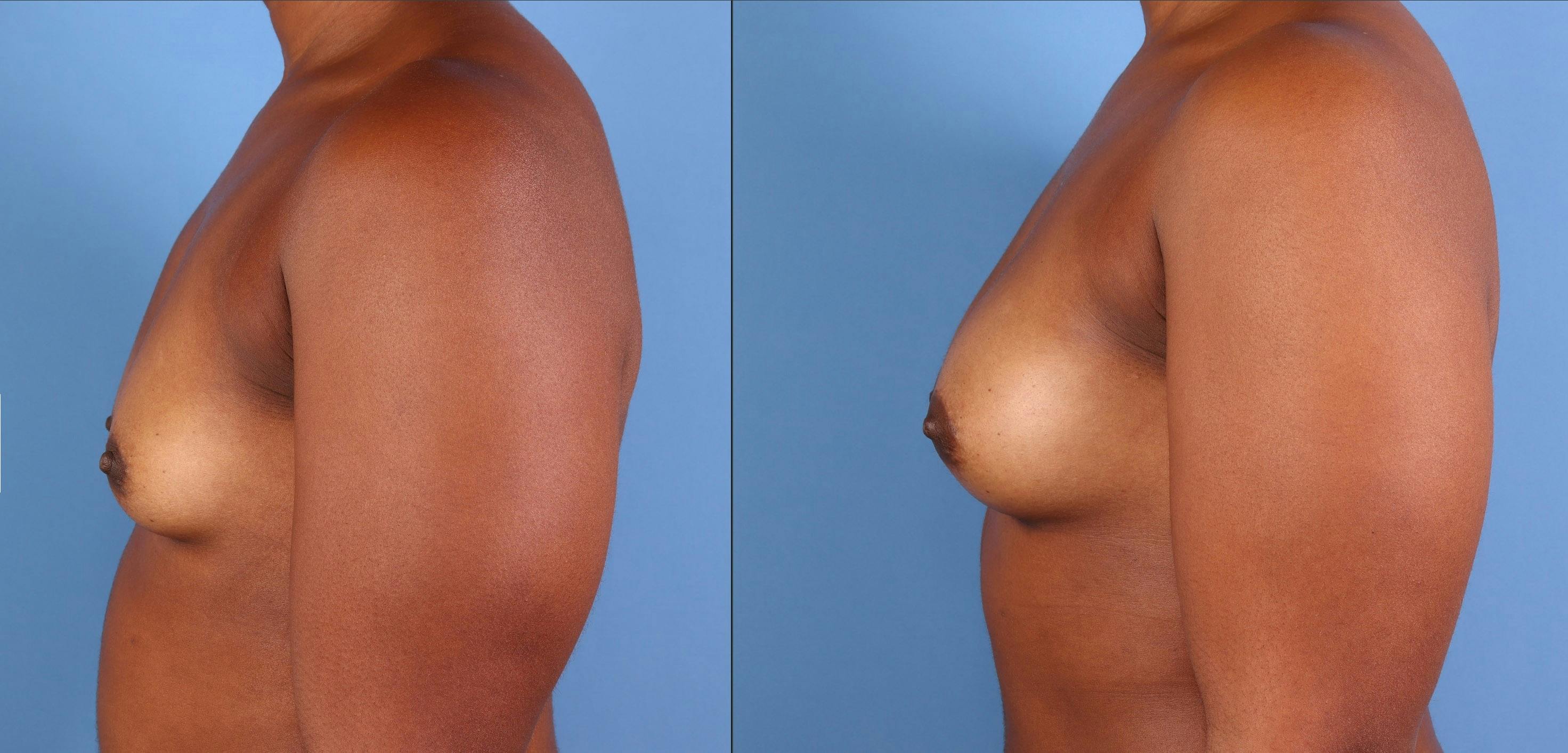 Fat Transfer Breast Augmentation Before & After Gallery - Patient 335855 - Image 3