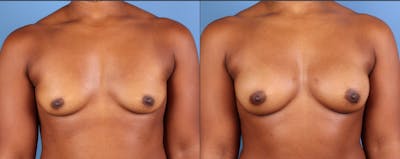 Fat Transfer Breast Augmentation Before & After Gallery - Patient 335855 - Image 1