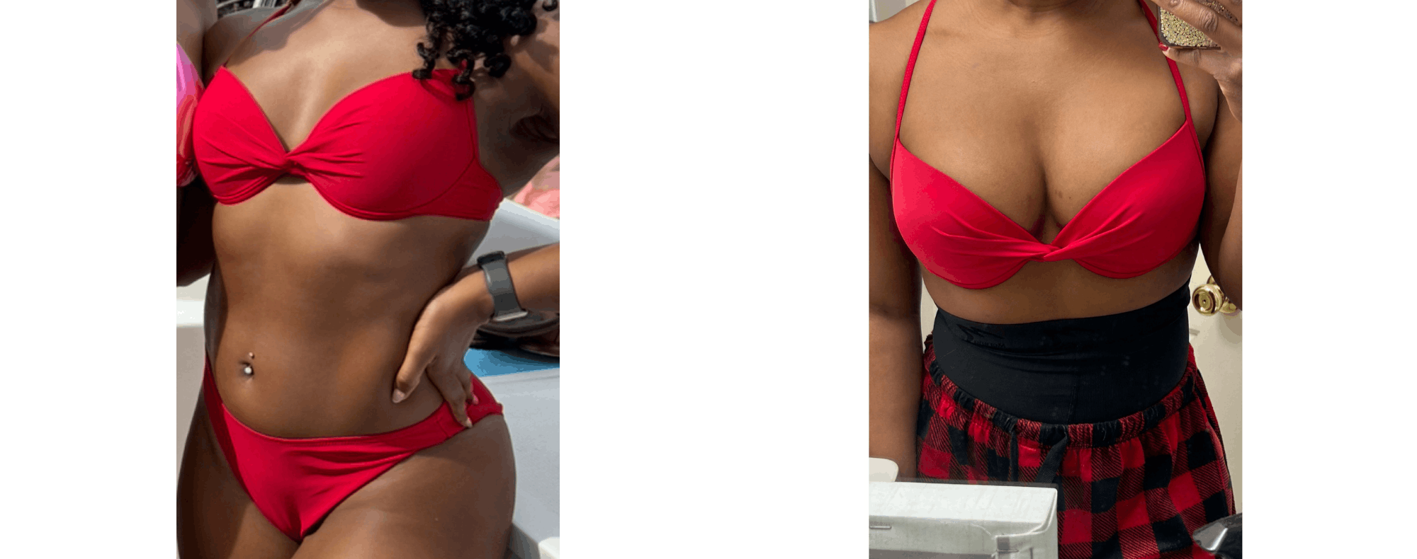 Fat Transfer Breast Augmentation Before & After Gallery - Patient 335855 - Image 6