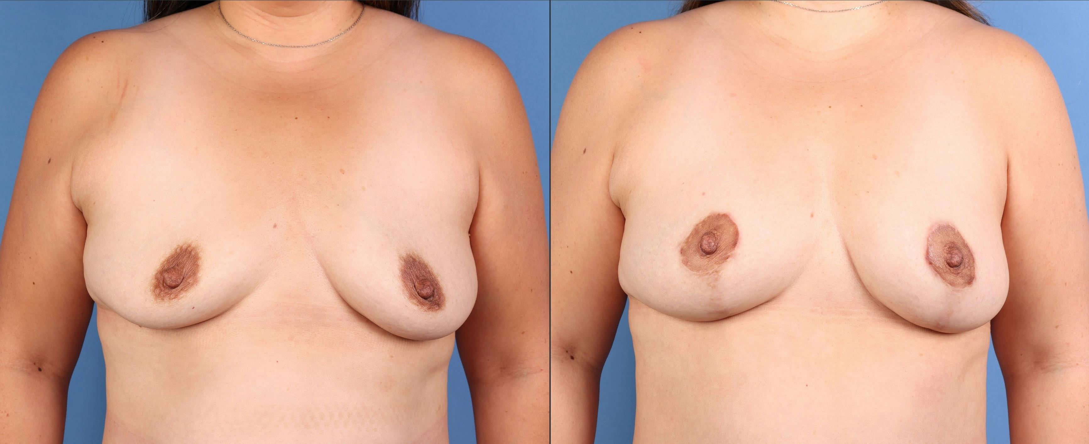 Breast Lift with Augmentation Before & After Gallery - Patient 158712 - Image 1