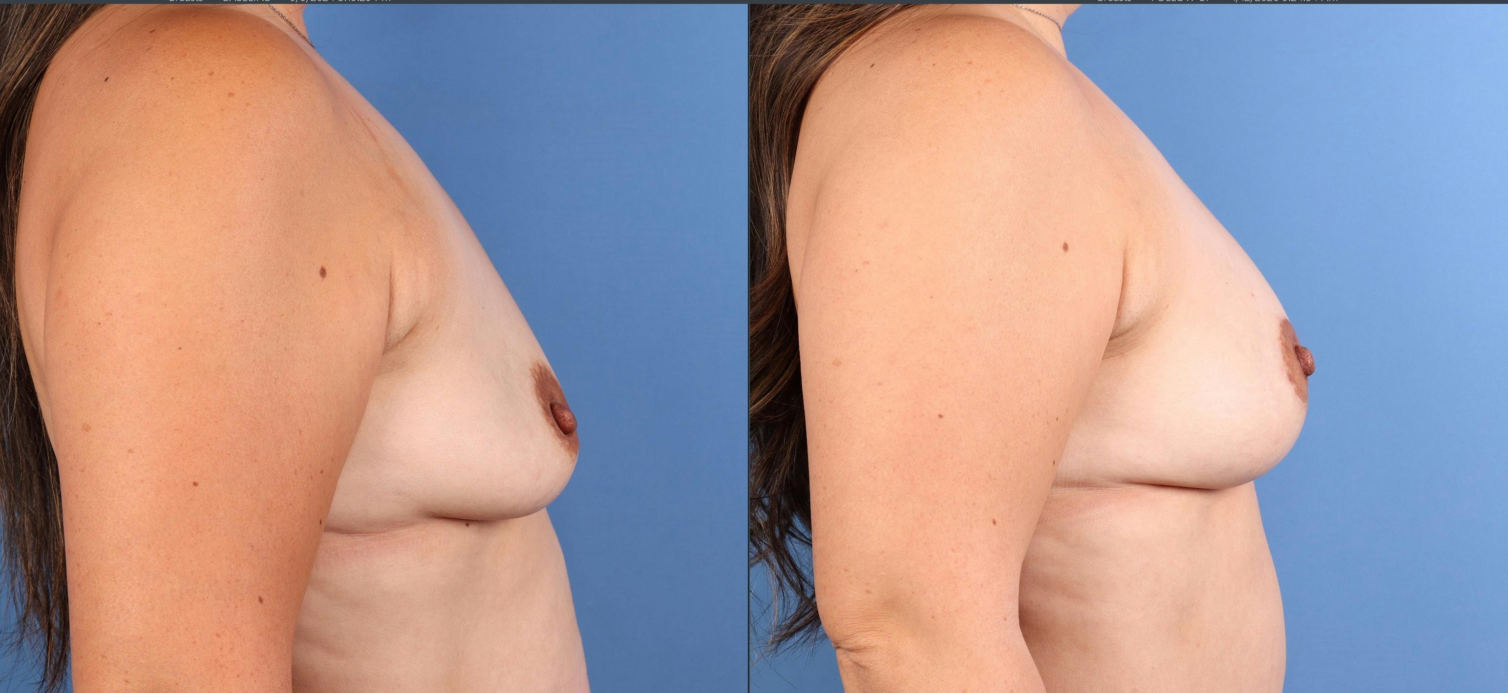 Breast Lift with Augmentation Before & After Gallery - Patient 158712 - Image 3