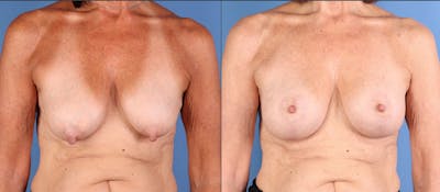Breast Lift with Augmentation Before & After Gallery - Patient 334487 - Image 1