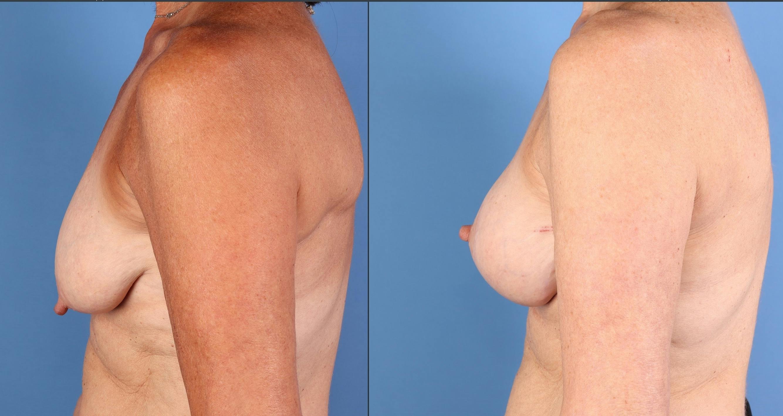 Breast Lift Before & After Gallery - Patient 344918 - Image 3