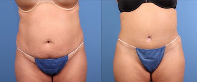 Tummy Tuck Before & After Gallery - Patient 124016 - Image 1