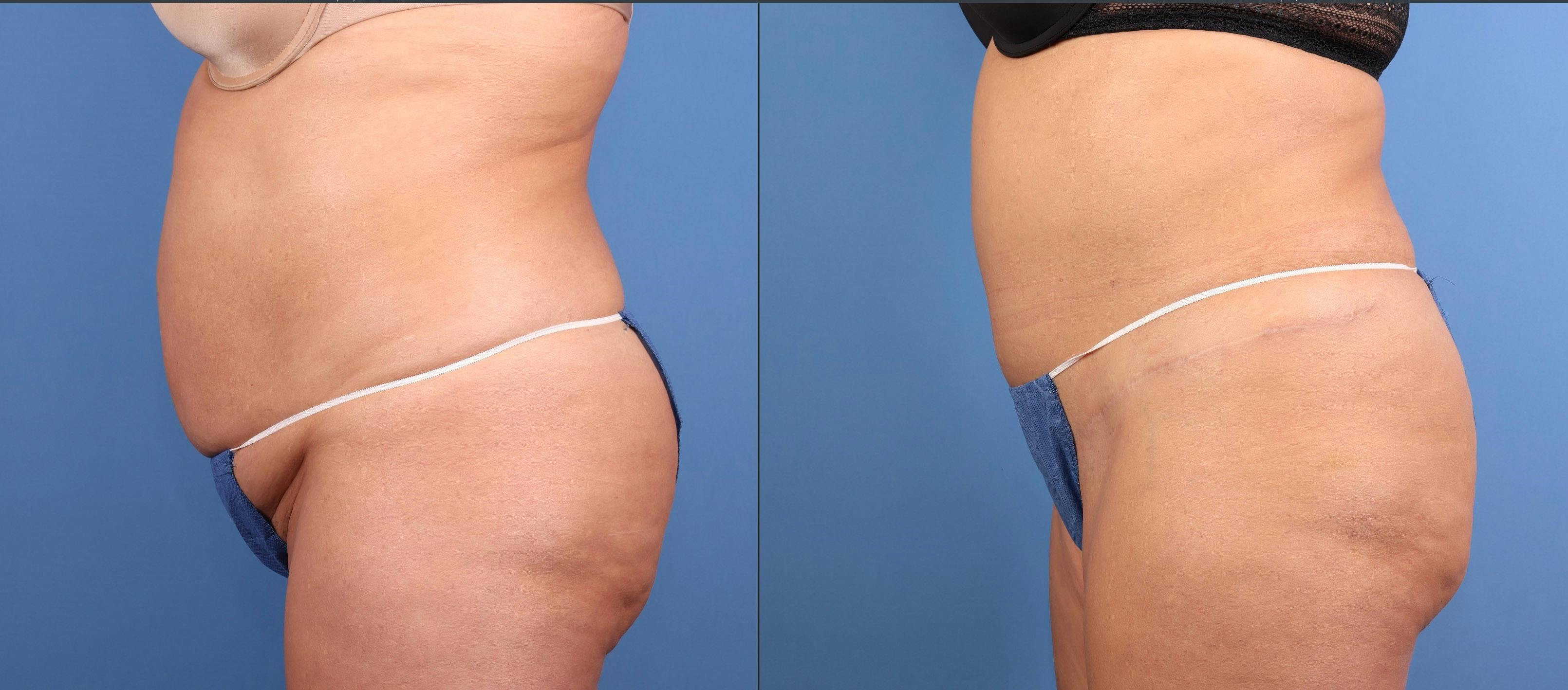 Abdomen Before & After Gallery - Patient 771821 - Image 3