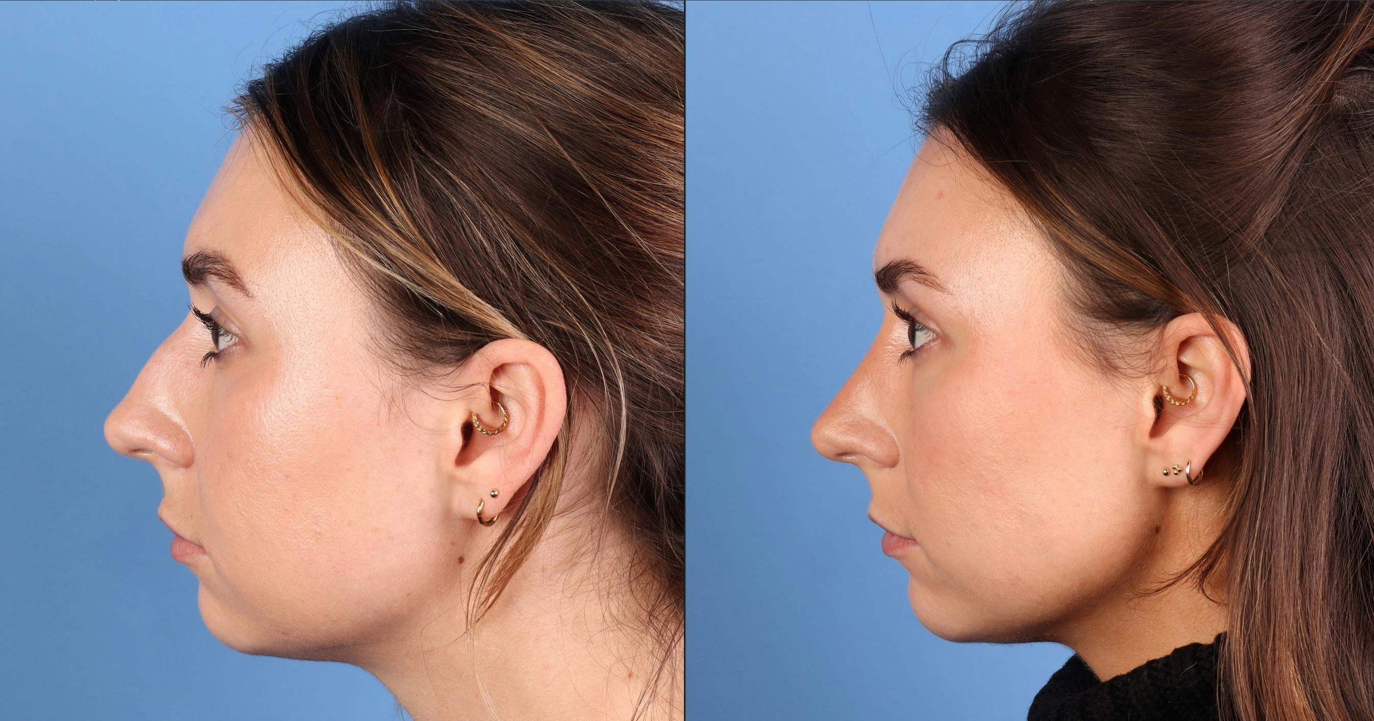 Rhinoplasty Before & After Gallery - Patient 274609 - Image 4