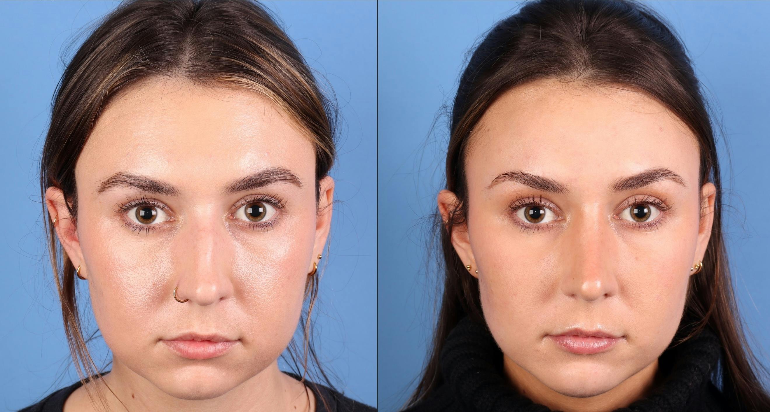 Rhinoplasty Before & After Gallery - Patient 274609 - Image 2