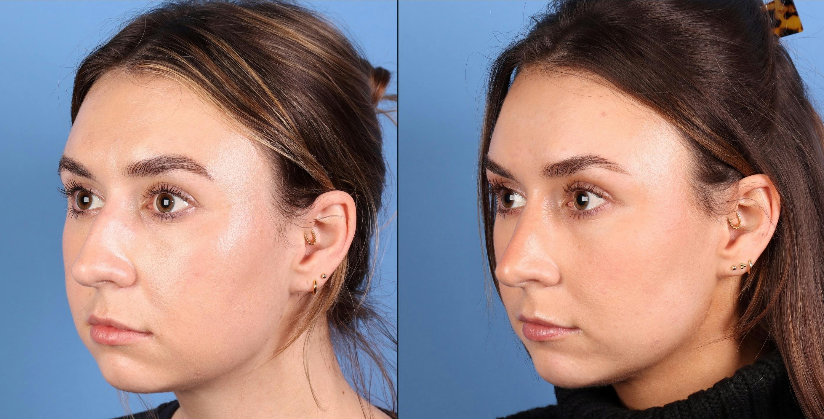 Rhinoplasty Before & After Gallery - Patient 274609 - Image 5