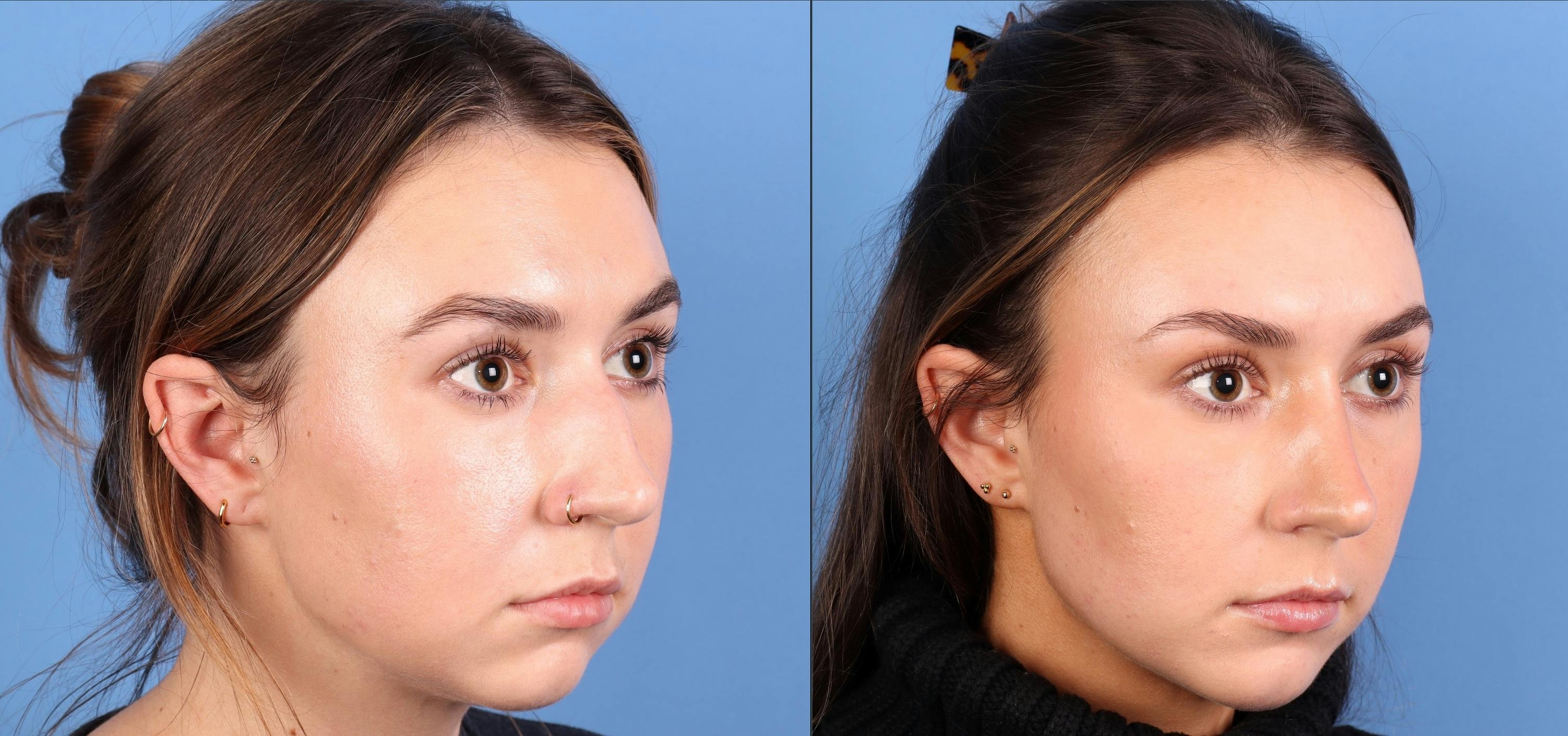 Rhinoplasty Before & After Gallery - Patient 274609 - Image 3