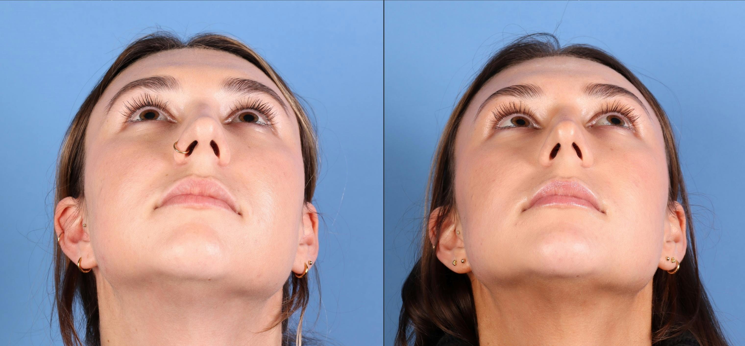 Rhinoplasty Before & After Gallery - Patient 274609 - Image 6