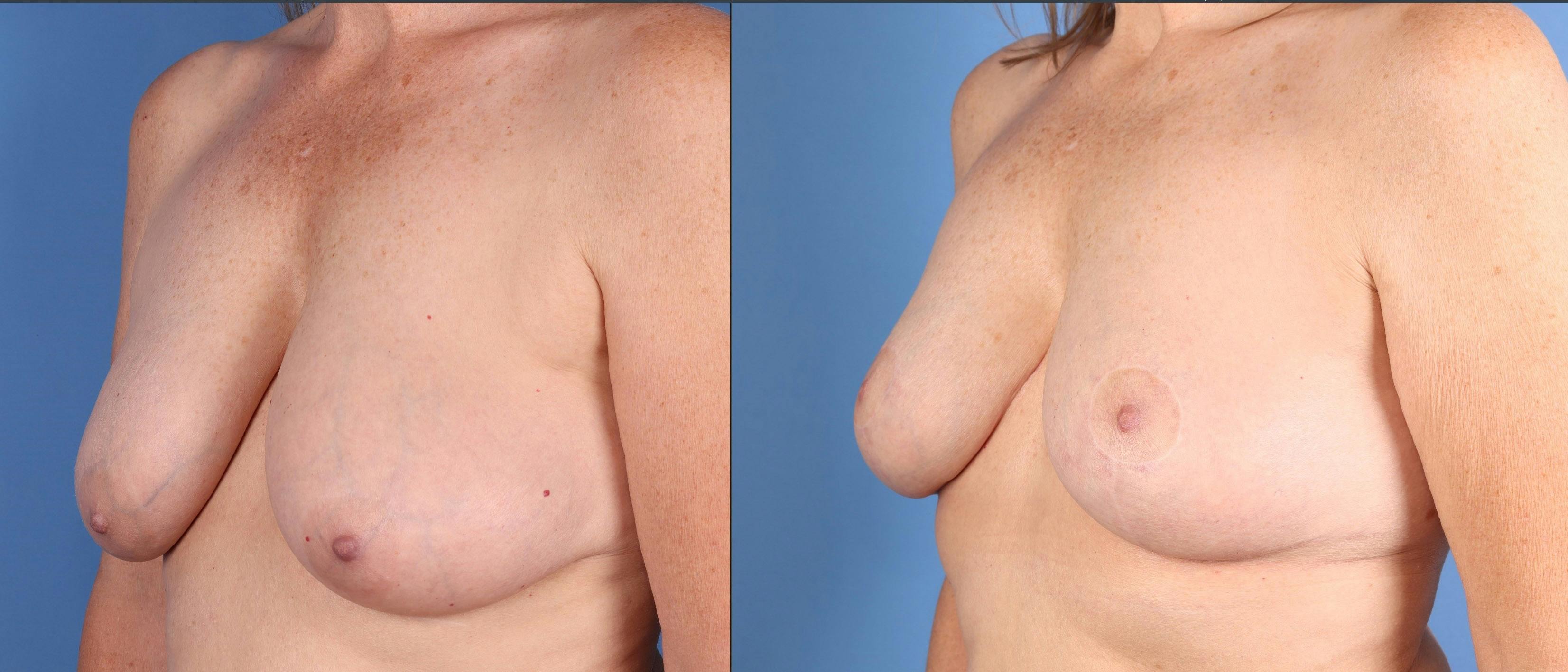 Breast Lift Before & After Gallery - Patient 212307 - Image 2