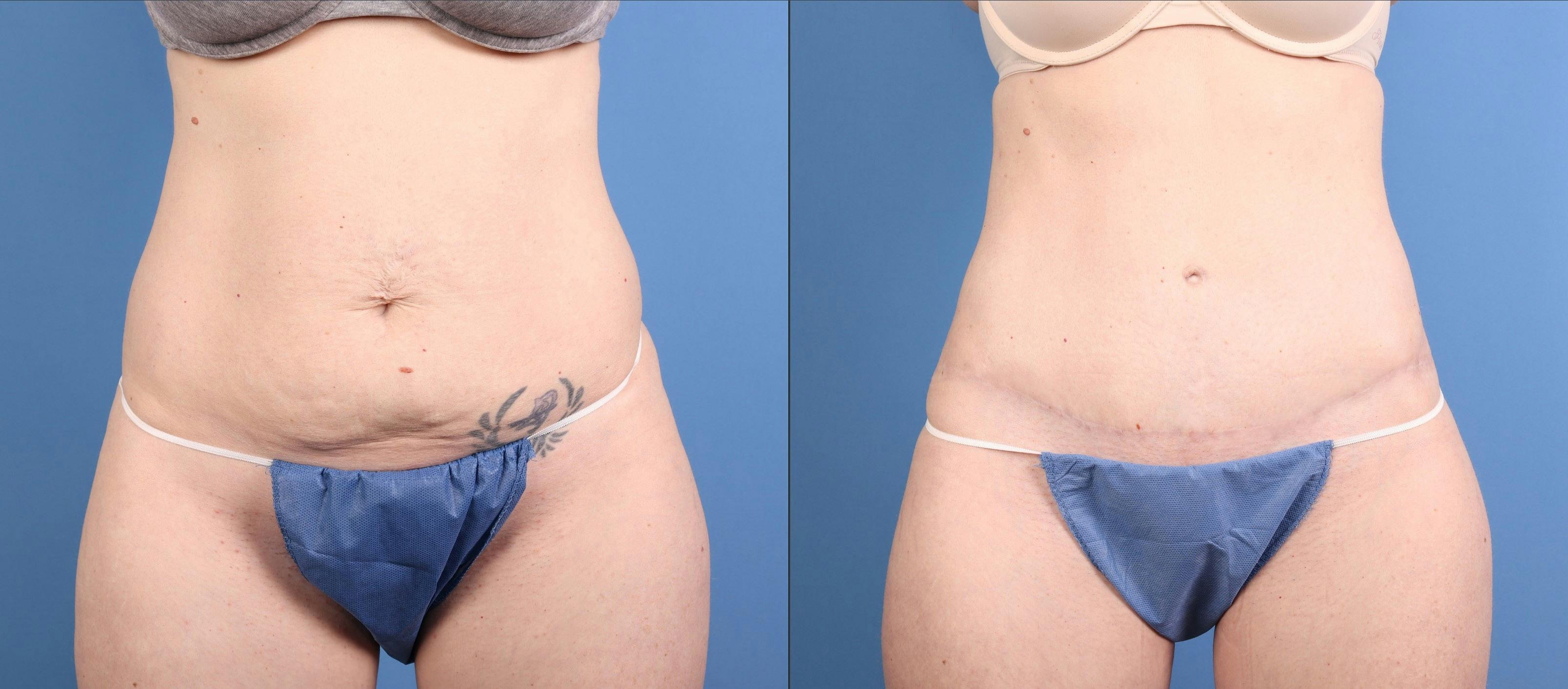 Tummy Tuck Before & After Gallery - Patient 169931 - Image 1