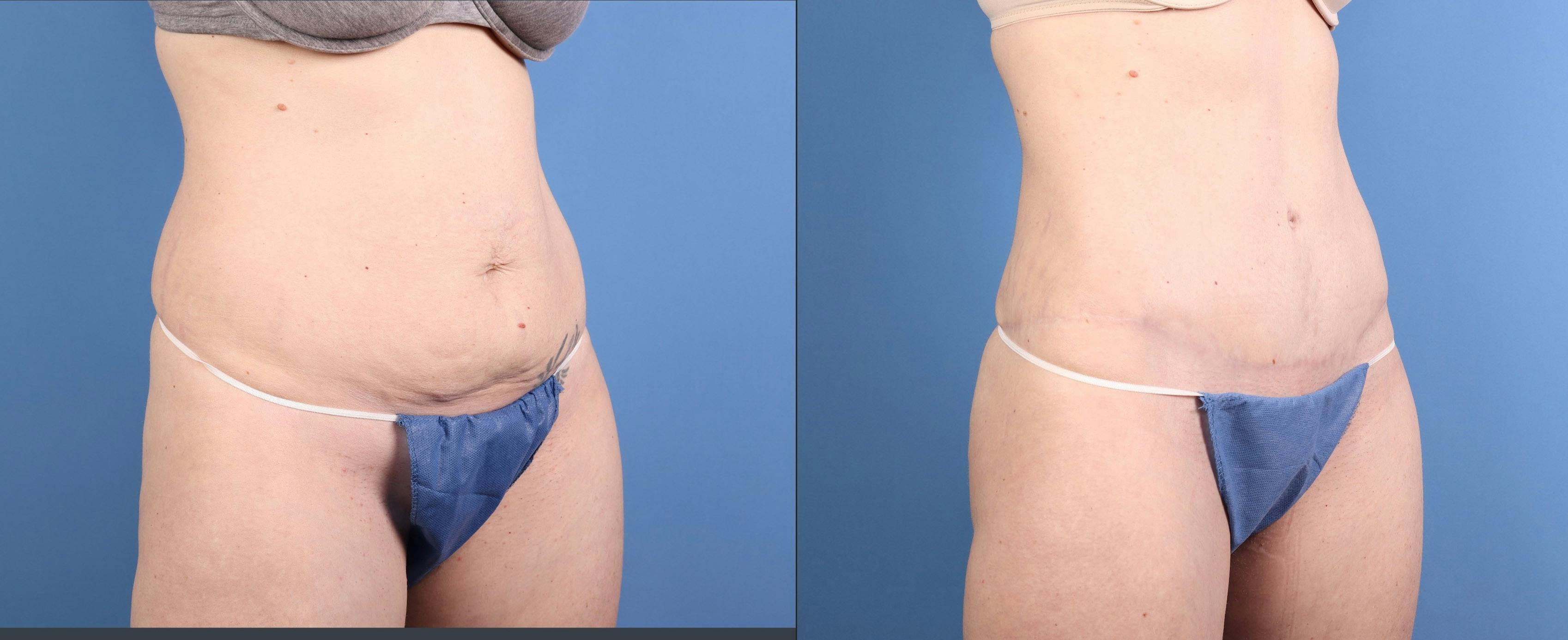 Tummy Tuck Before & After Gallery - Patient 169931 - Image 2