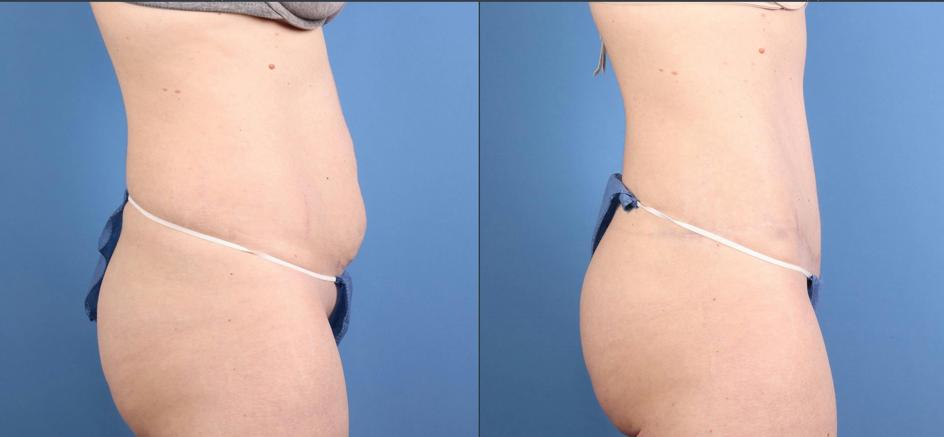 Tummy Tuck Before & After Gallery - Patient 169931 - Image 3