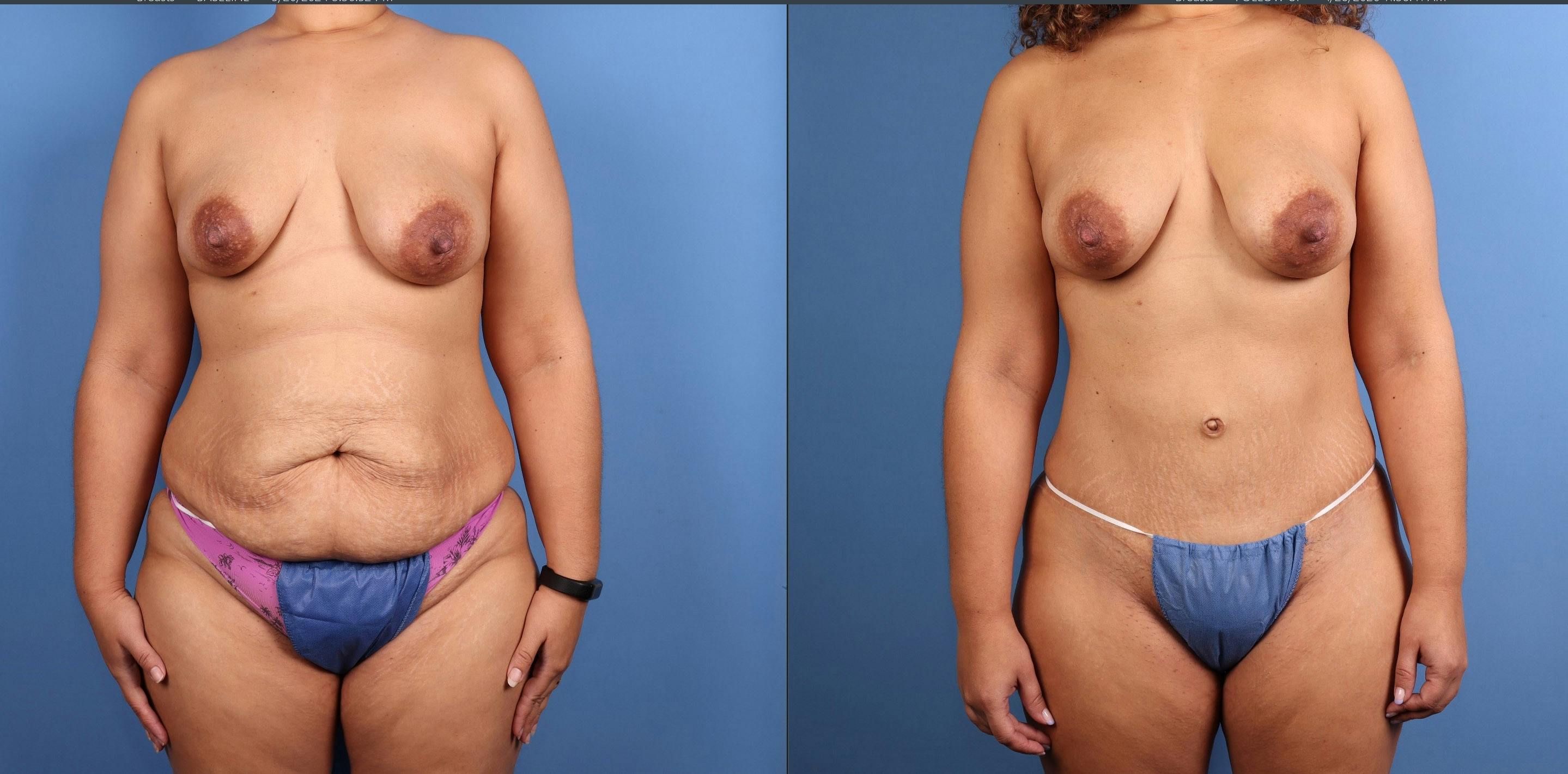 Tummy Tuck Before & After Gallery - Patient 606601 - Image 4