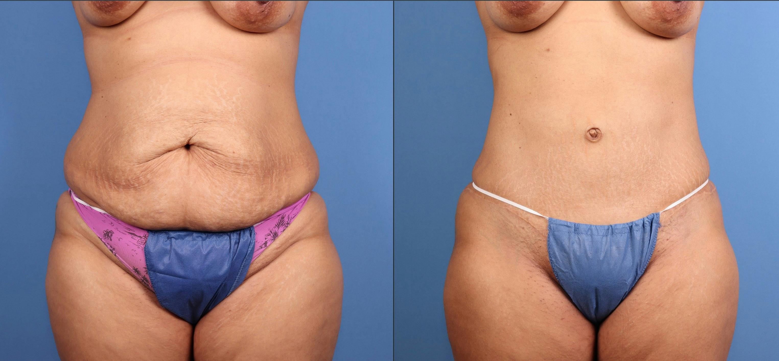 Tummy Tuck Before & After Gallery - Patient 606601 - Image 1