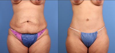 Tummy Tuck Before & After Gallery - Patient 606601 - Image 1