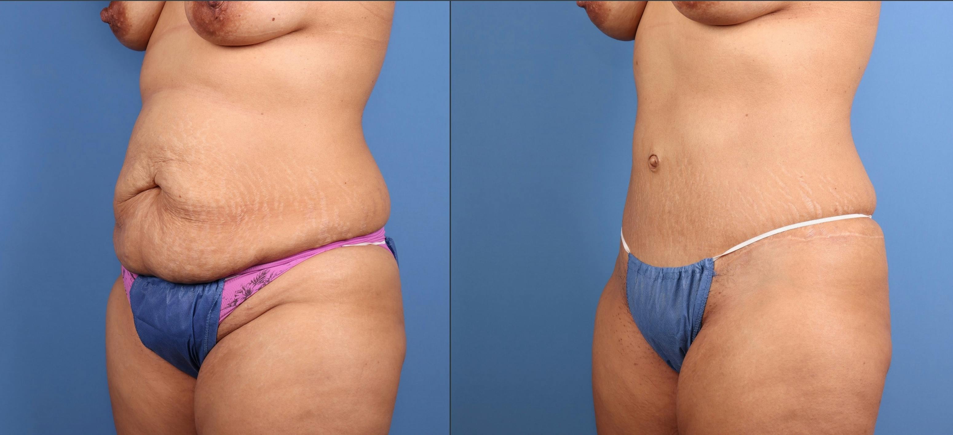Tummy Tuck Before & After Gallery - Patient 606601 - Image 2