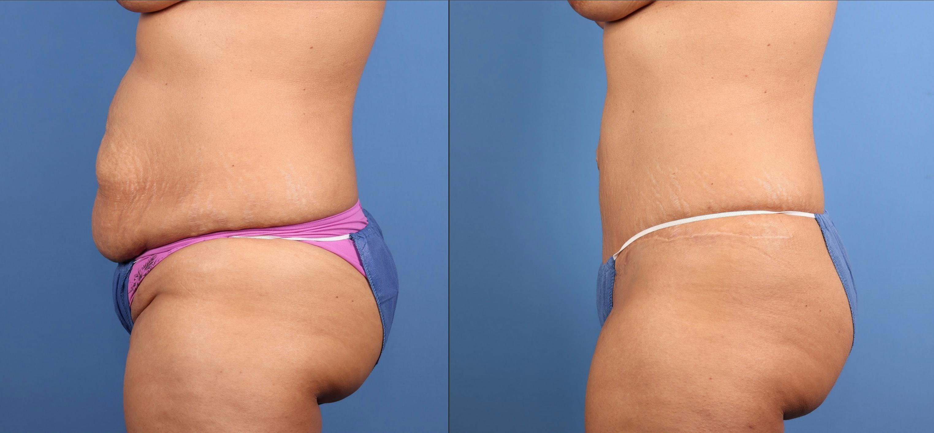Tummy Tuck Before & After Gallery - Patient 606601 - Image 3