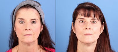 Face Lift Before & After Gallery - Patient 422611 - Image 1