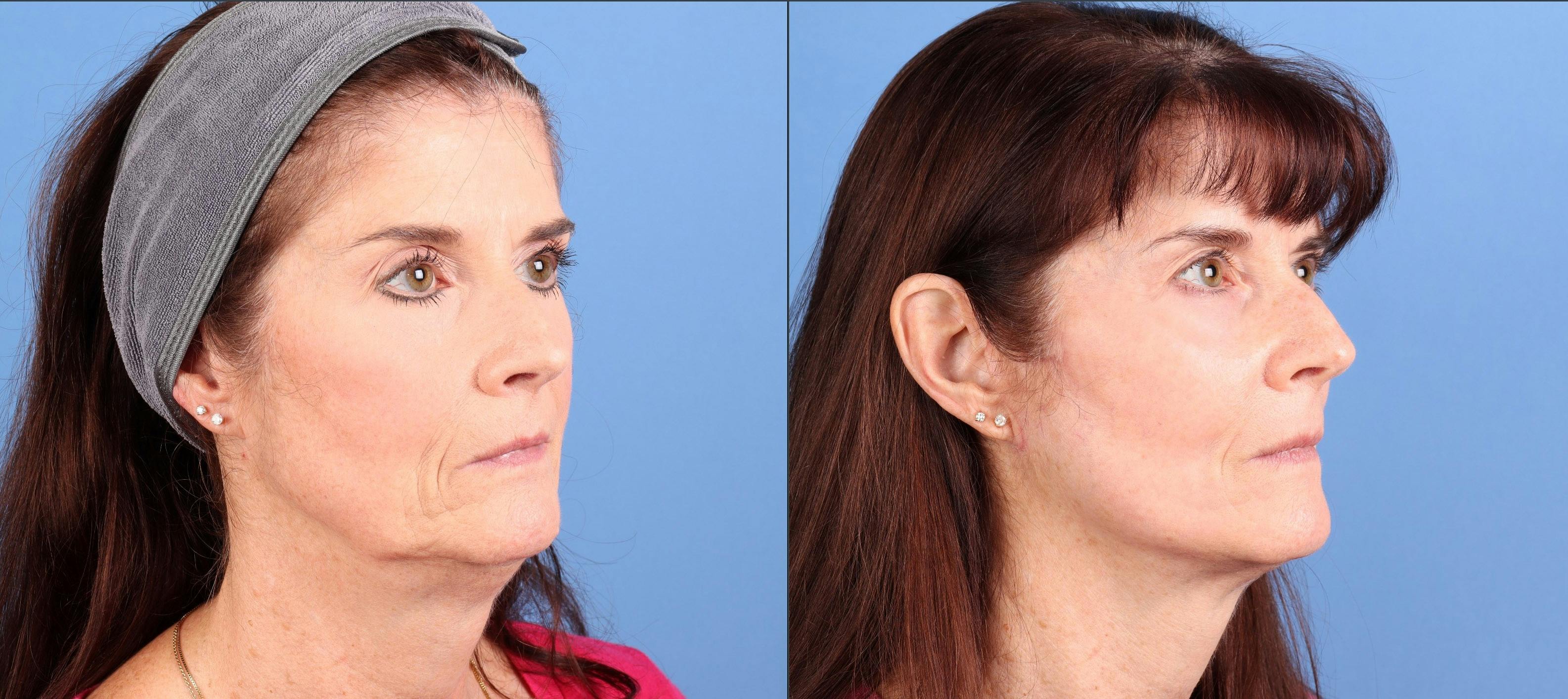 Face Lift Before & After Gallery - Patient 422611 - Image 2