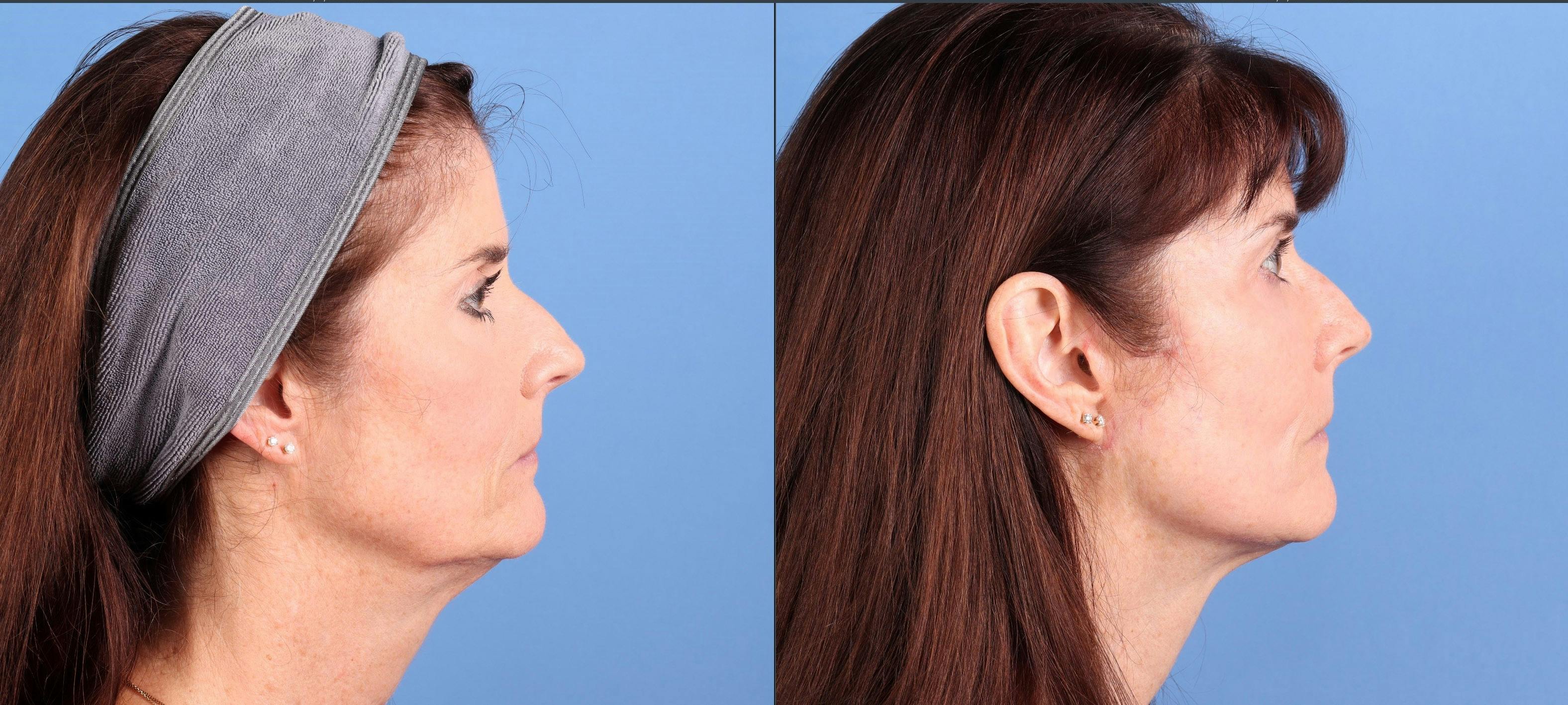 Face Lift Before & After Gallery - Patient 422611 - Image 3